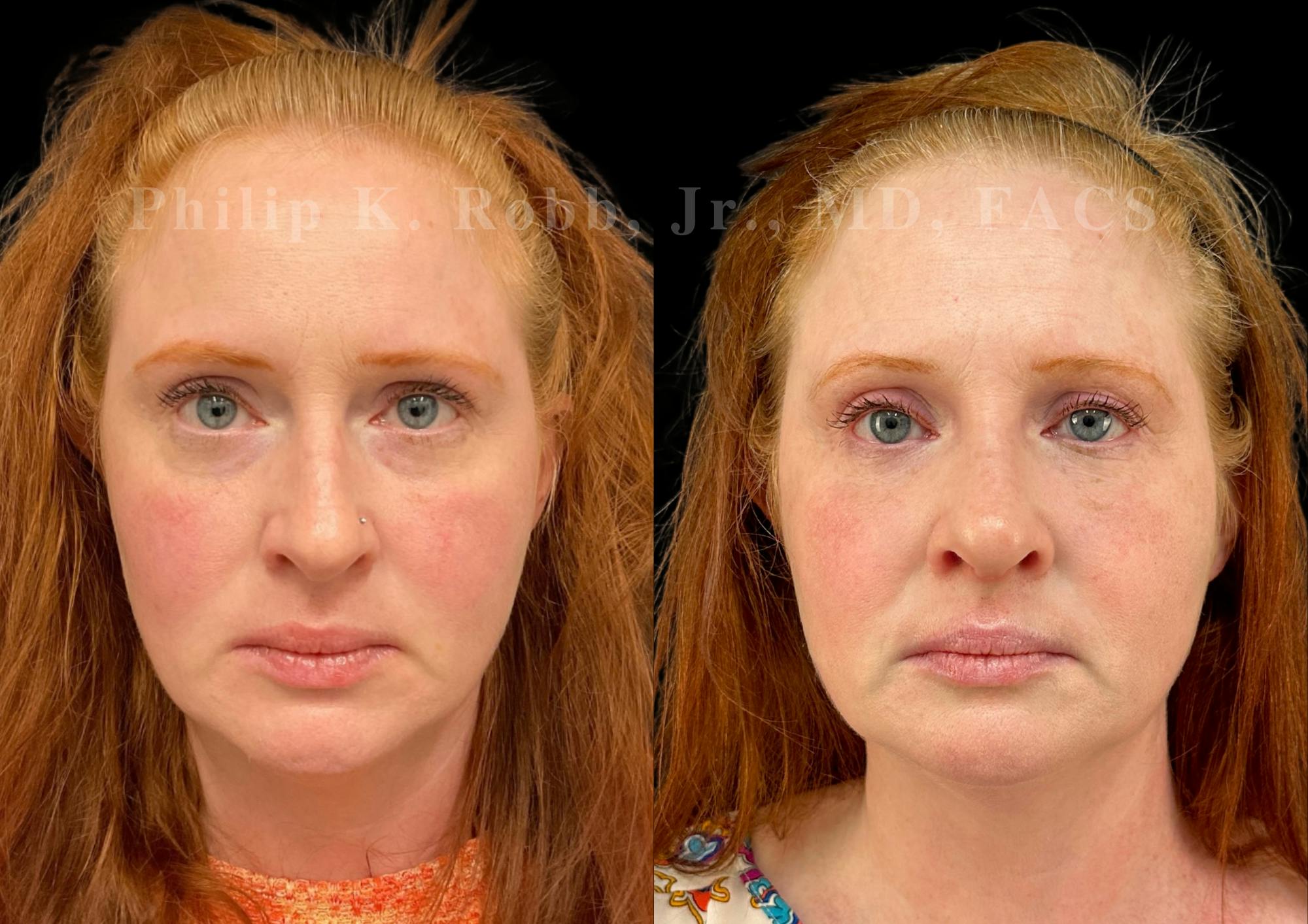 Ultrasonic Rhinoplasty Before & After Gallery - Patient 124732 - Image 3