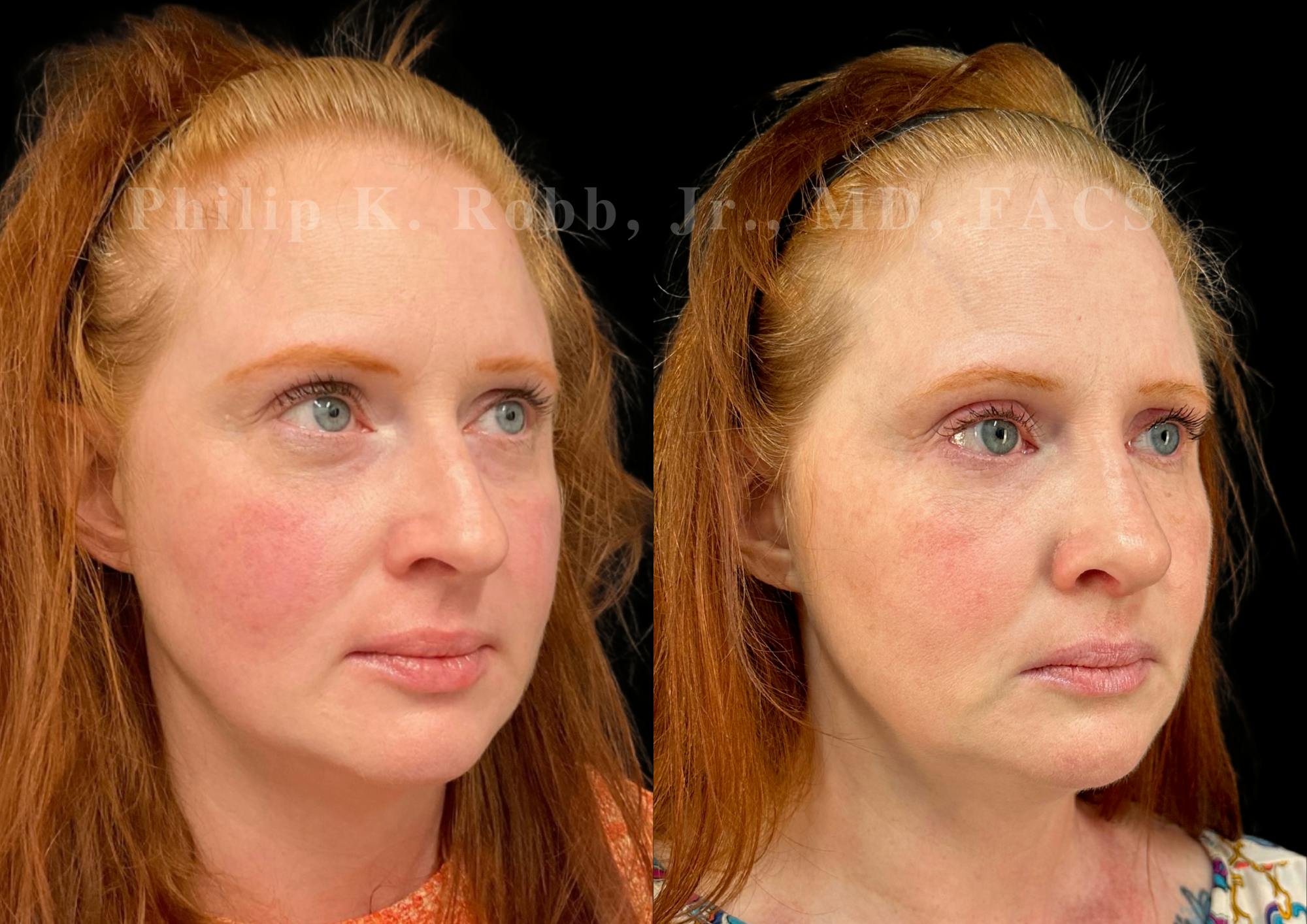 Ultrasonic Rhinoplasty Before & After Gallery - Patient 124732 - Image 2