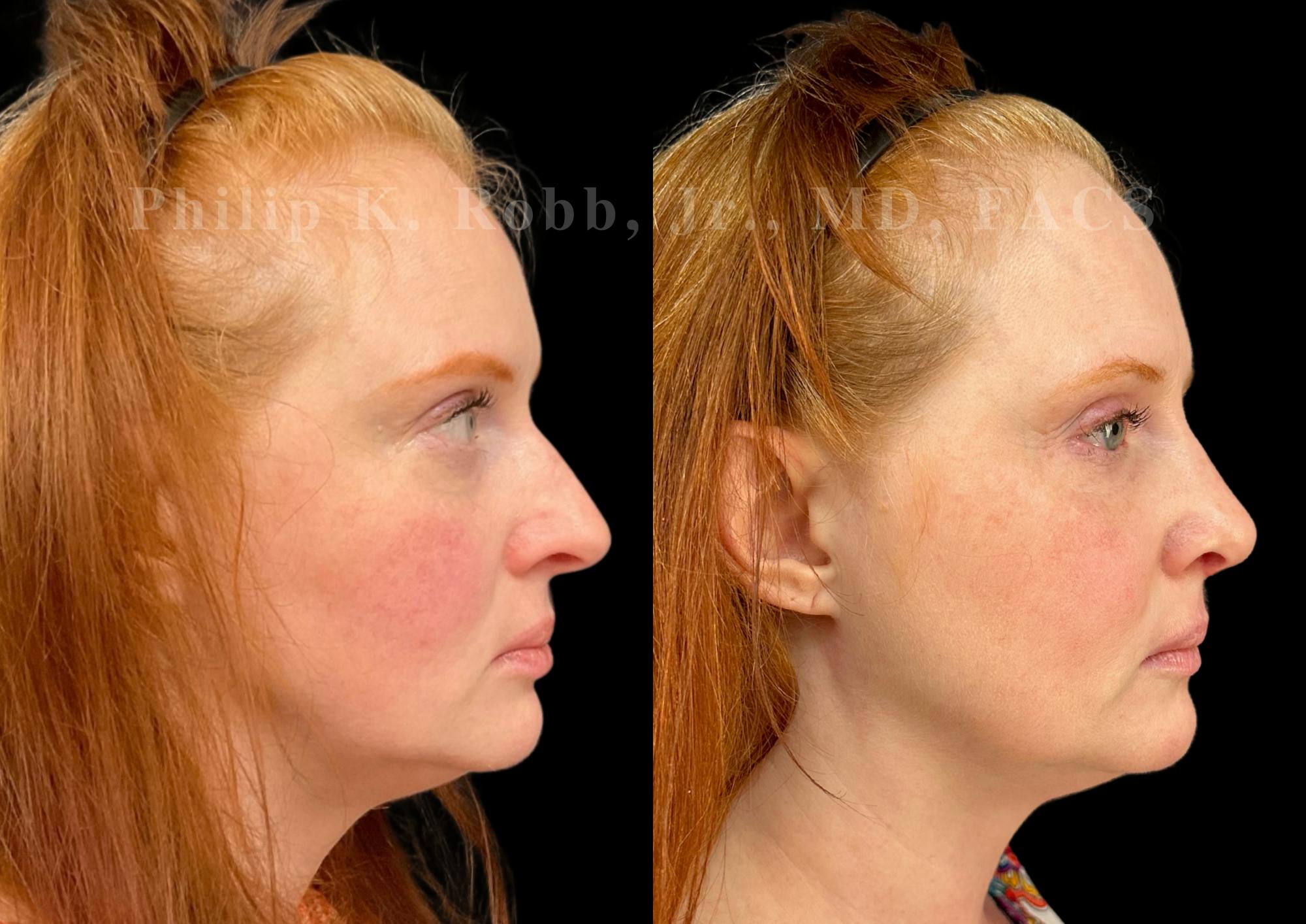 Ultrasonic Rhinoplasty Before & After Gallery - Patient 124732 - Image 1