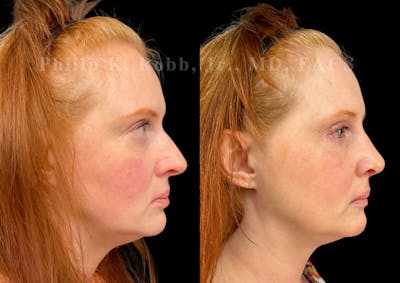 Ultrasonic Rhinoplasty Before & After Gallery - Patient 124732 - Image 1