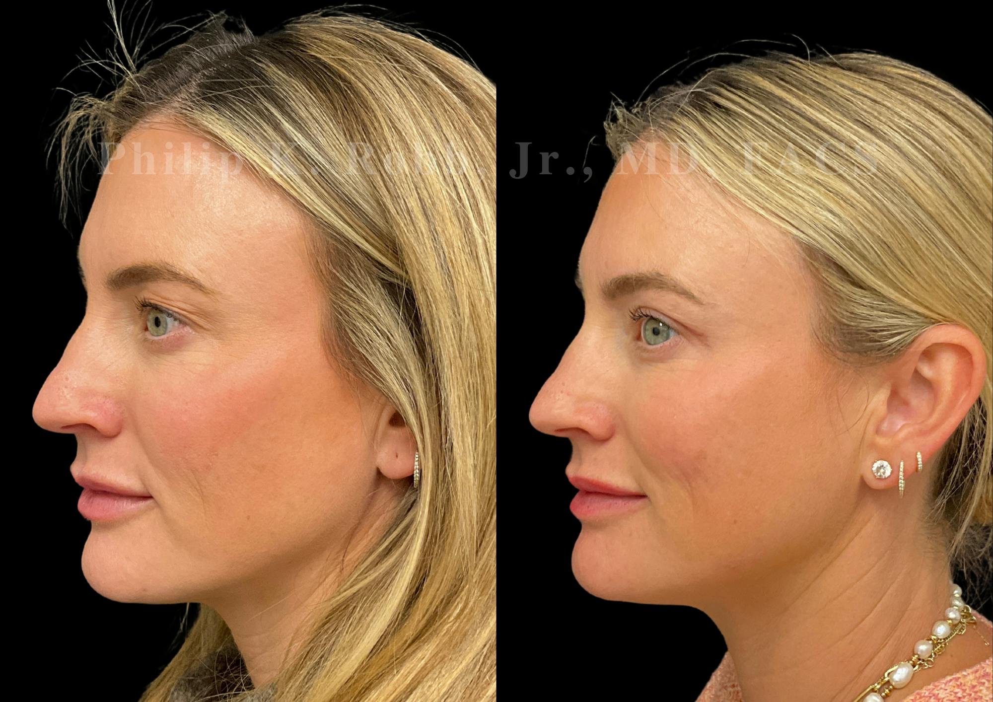 Upper Blepharoplasty Before & After Gallery - Patient 322415 - Image 2