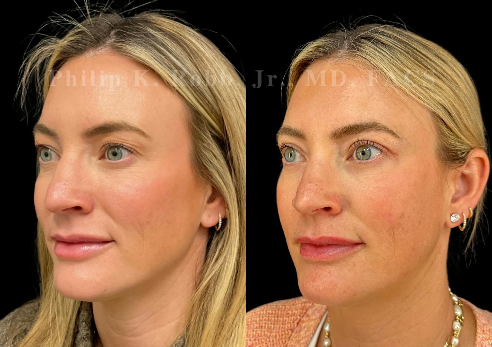 Upper Blepharoplasty Before & After Gallery - Patient 322415 - Image 3