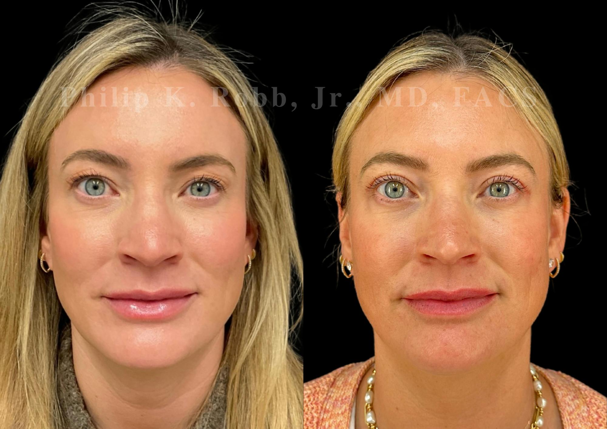 Upper Blepharoplasty Before & After Gallery - Patient 322415 - Image 1