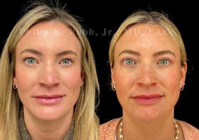 Upper Blepharoplasty Before & After Gallery - Patient 322415 - Image 1