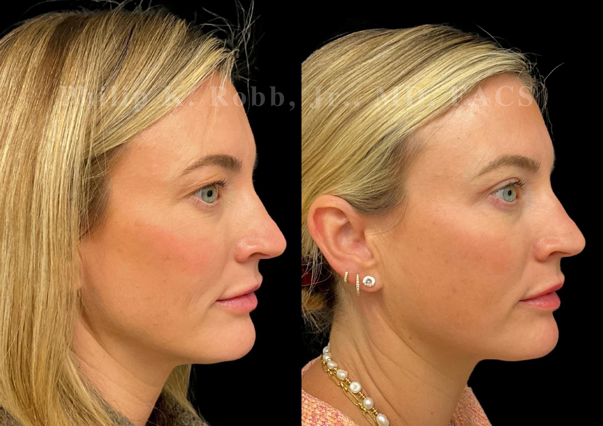Upper Blepharoplasty Before & After Gallery - Patient 322415 - Image 5