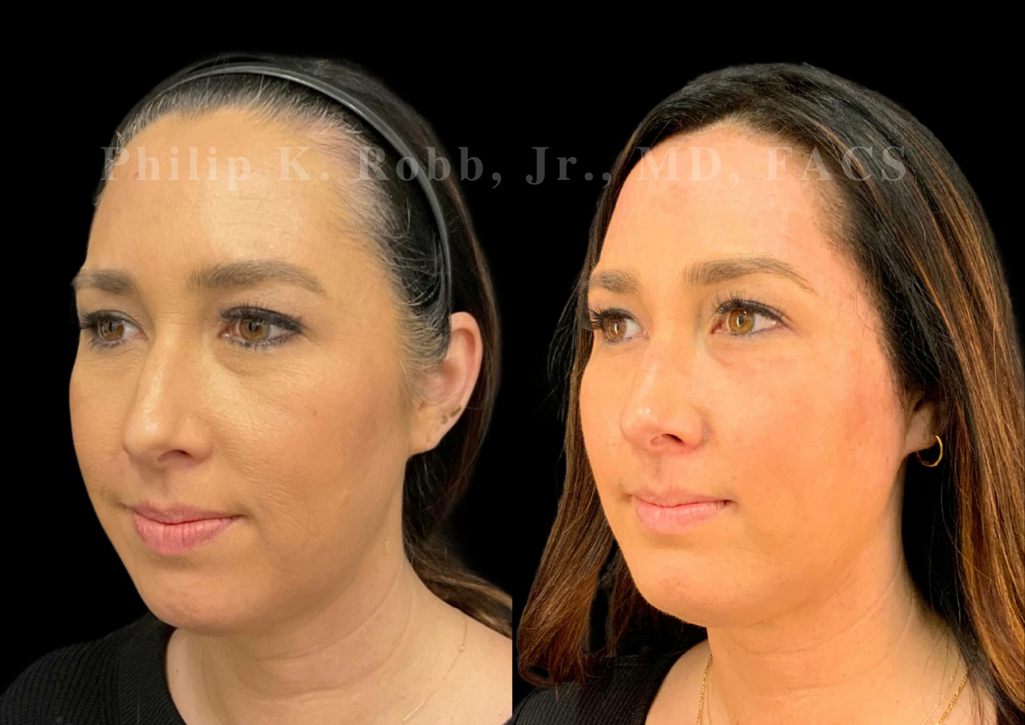 Buccal Fat Reduction Before & After Gallery - Patient 880882 - Image 3