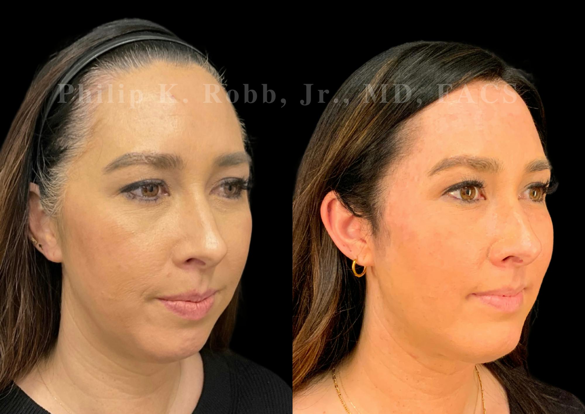 Buccal Fat Reduction Before & After Gallery - Patient 880882 - Image 4