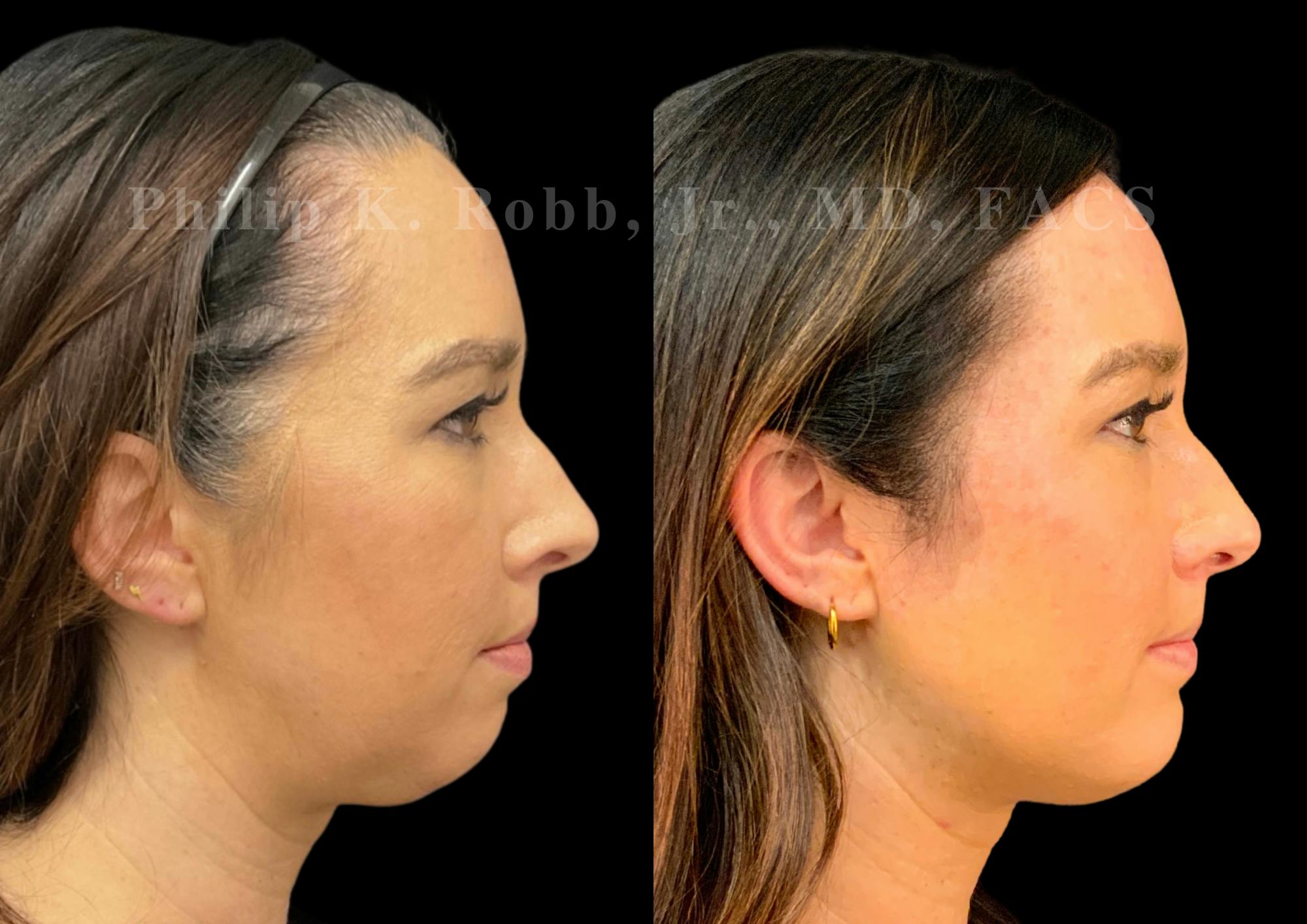 Buccal Fat Reduction Before & After Gallery - Patient 880882 - Image 5