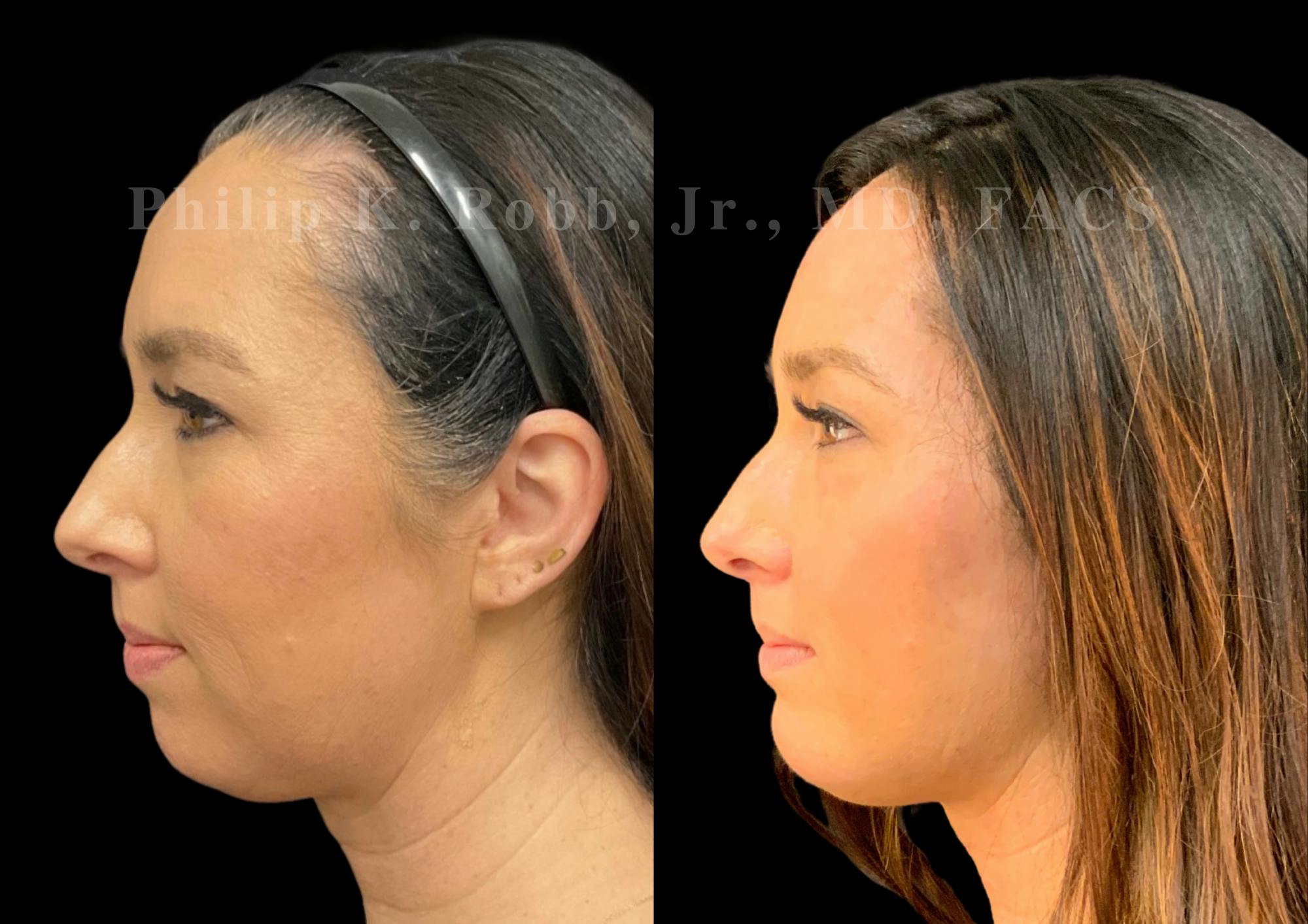 Buccal Fat Reduction Before & After Gallery - Patient 880882 - Image 2