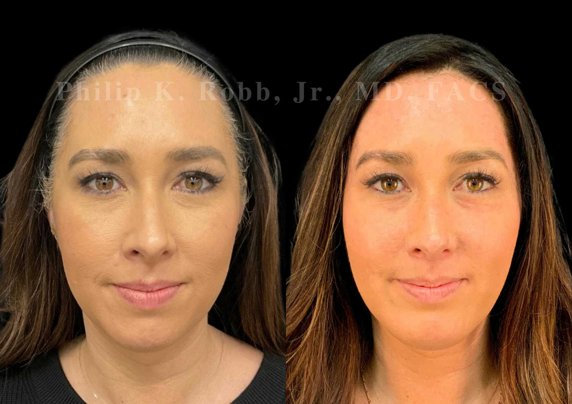 Buccal Fat Reduction Before & After Gallery - Patient 880882 - Image 1
