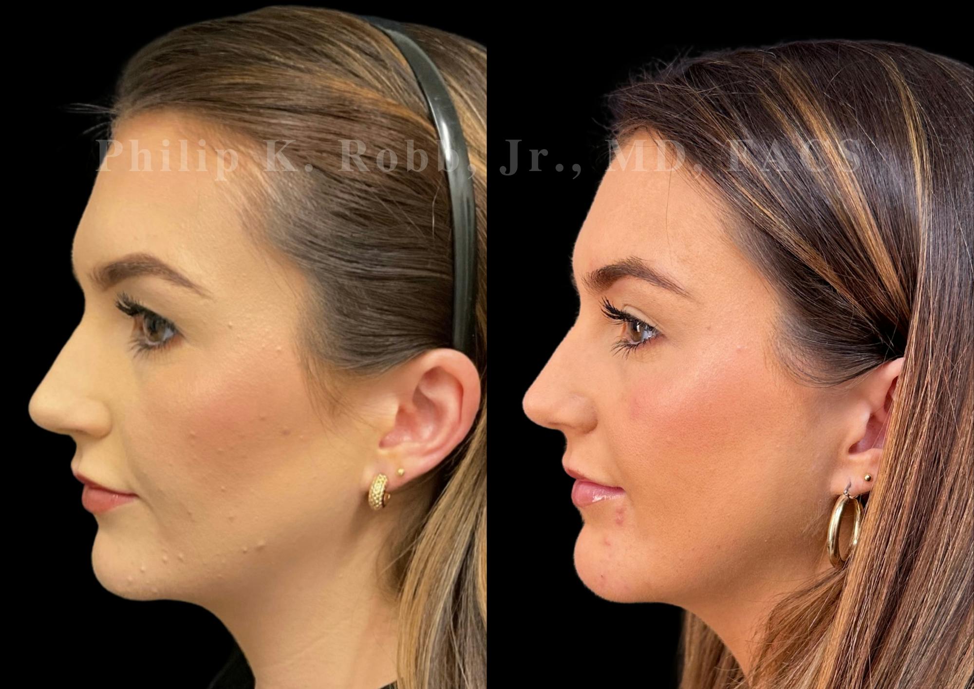 Chin Augmentation Before & After Gallery - Patient 104894 - Image 1