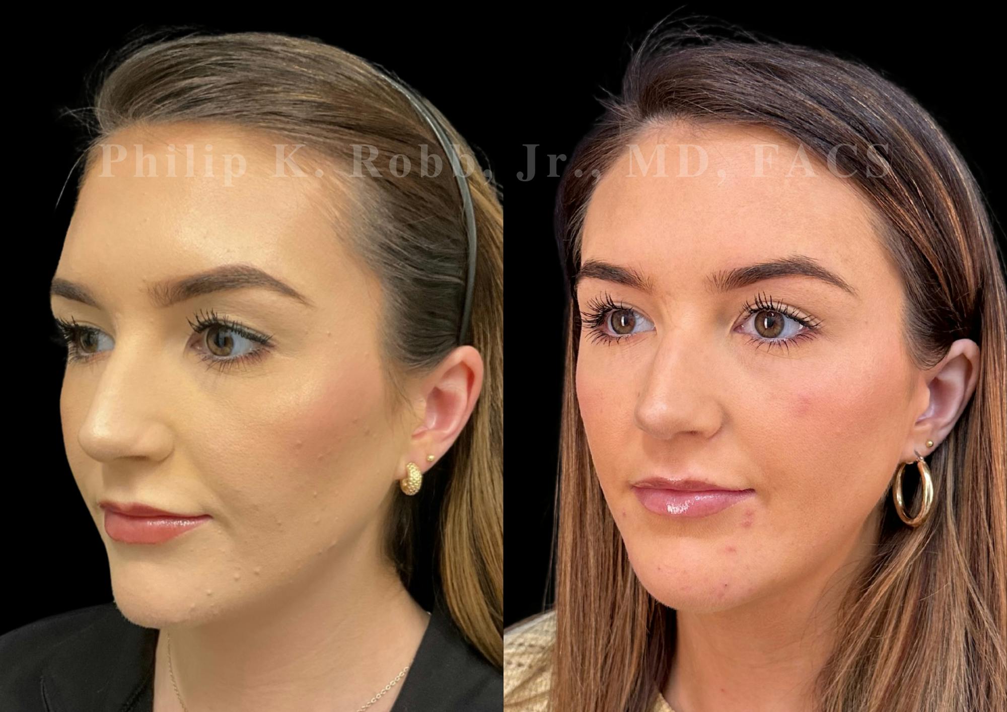 Chin Augmentation Before & After Gallery - Patient 104894 - Image 2
