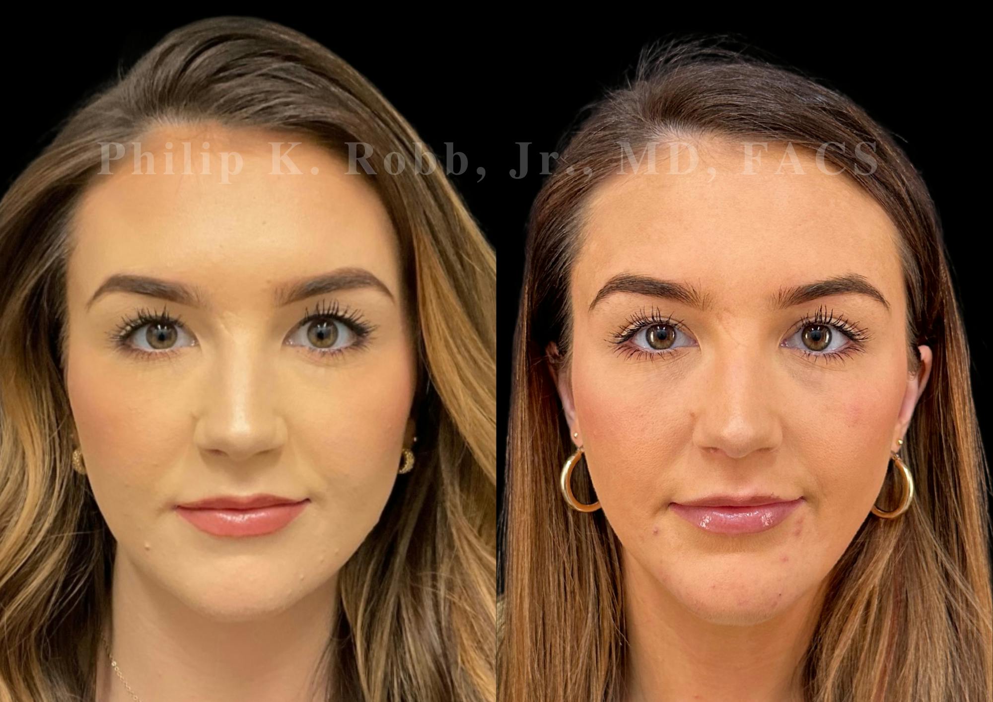 Chin Augmentation Before & After Gallery - Patient 104894 - Image 3