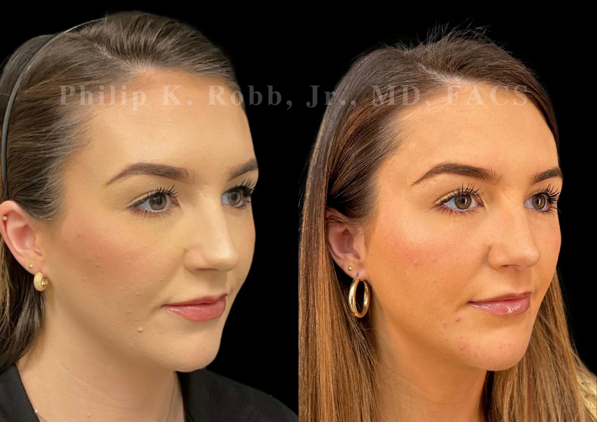 Chin Augmentation Before & After Gallery - Patient 104894 - Image 4