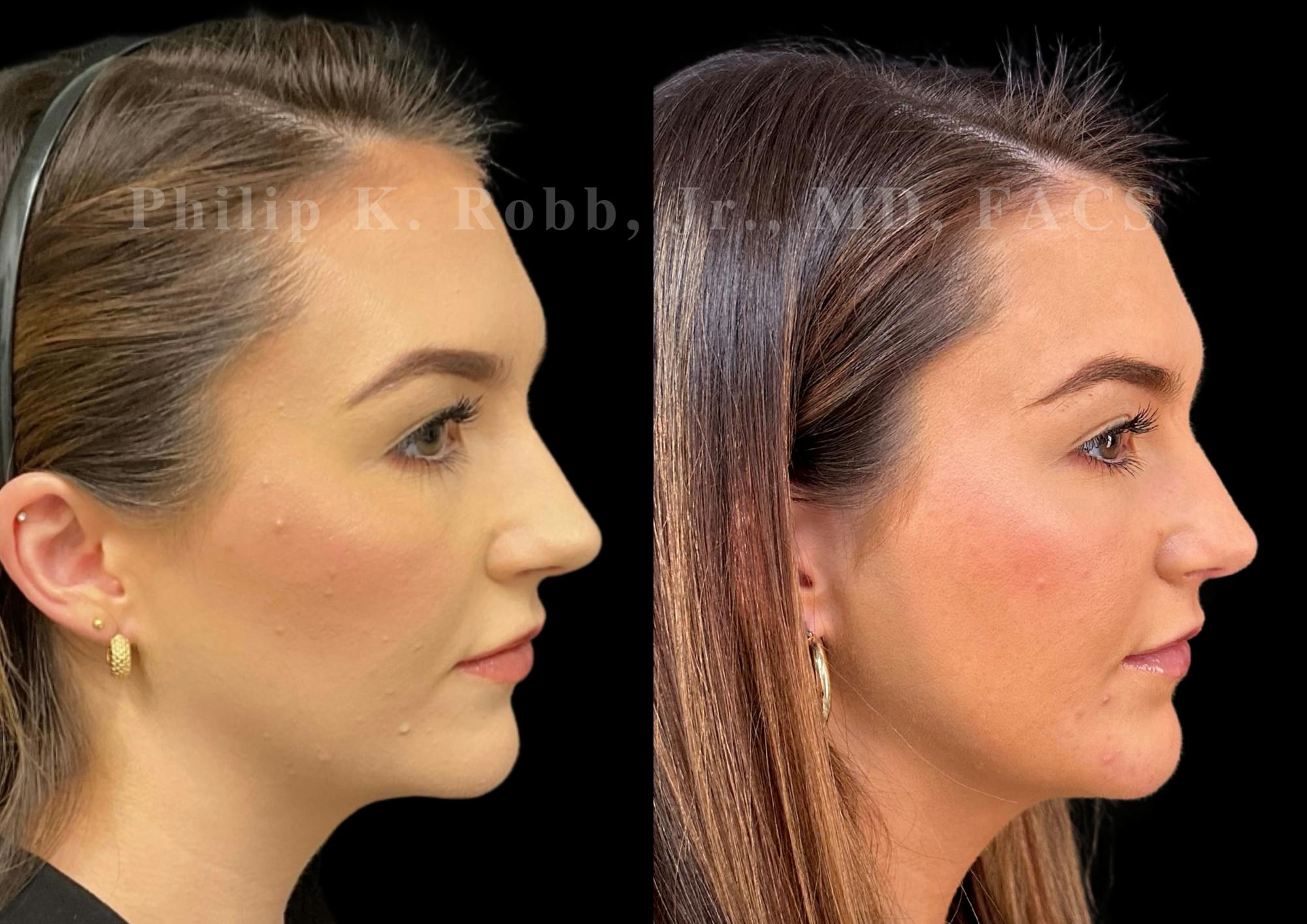 Chin Augmentation Before & After Gallery - Patient 104894 - Image 5