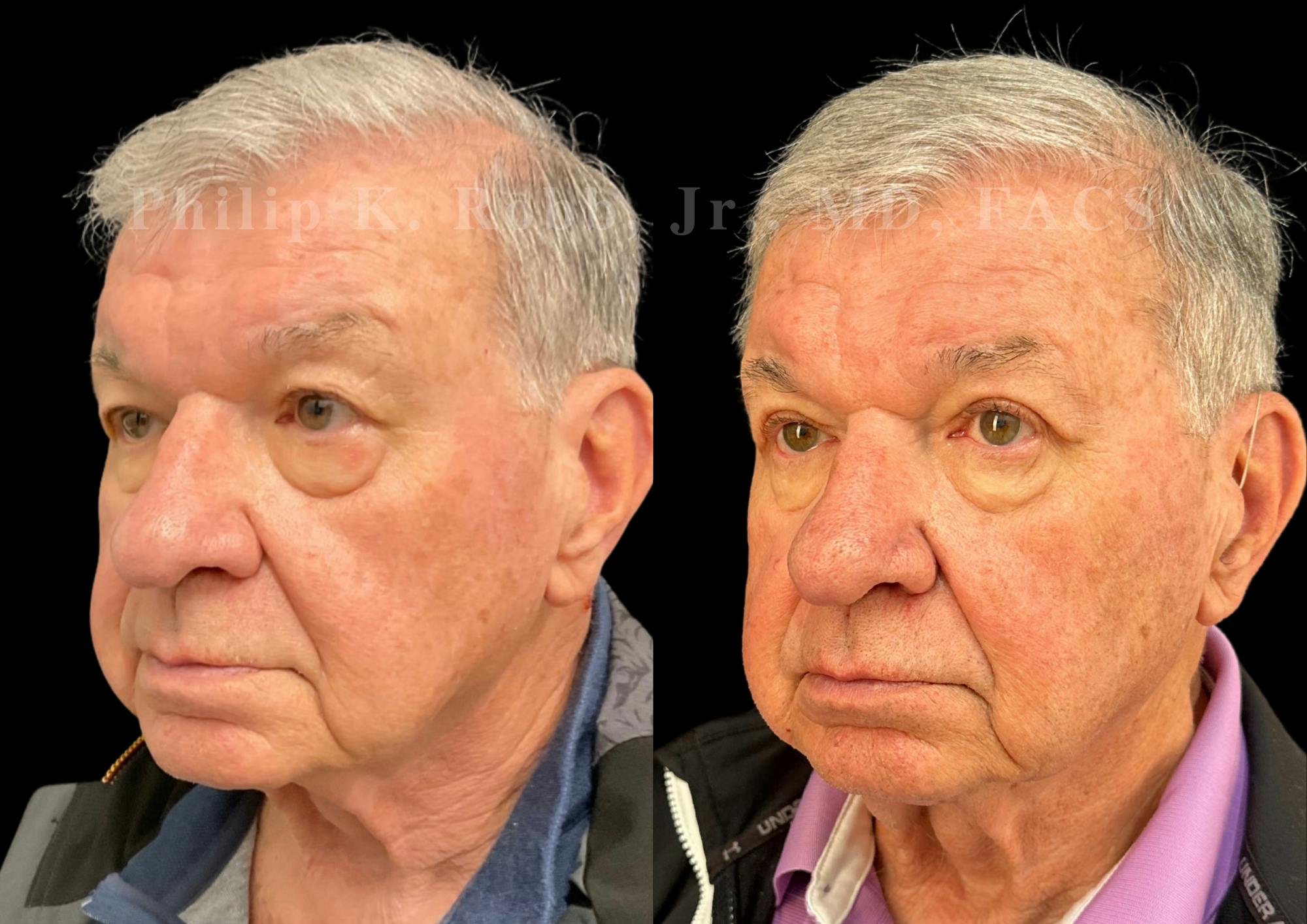 Upper Blepharoplasty Before & After Gallery - Patient 408485 - Image 2
