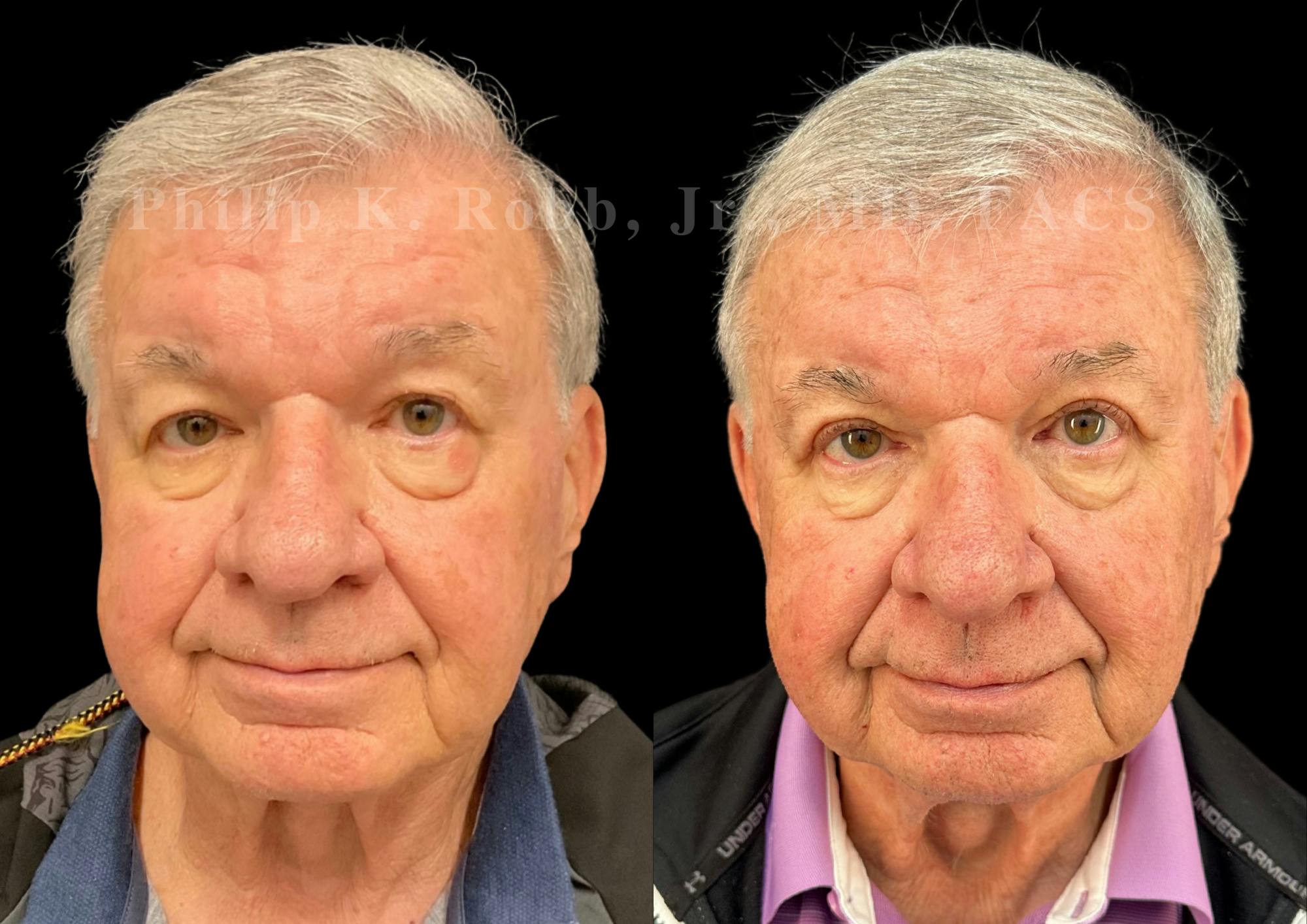 Upper Blepharoplasty Before & After Gallery - Patient 408485 - Image 1