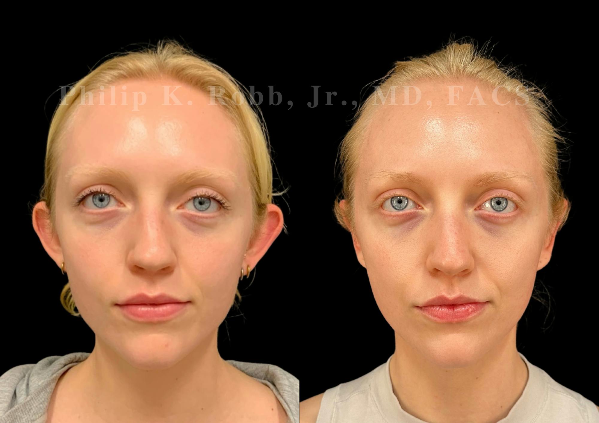 Otoplasty Before & After Gallery - Patient 159810 - Image 1