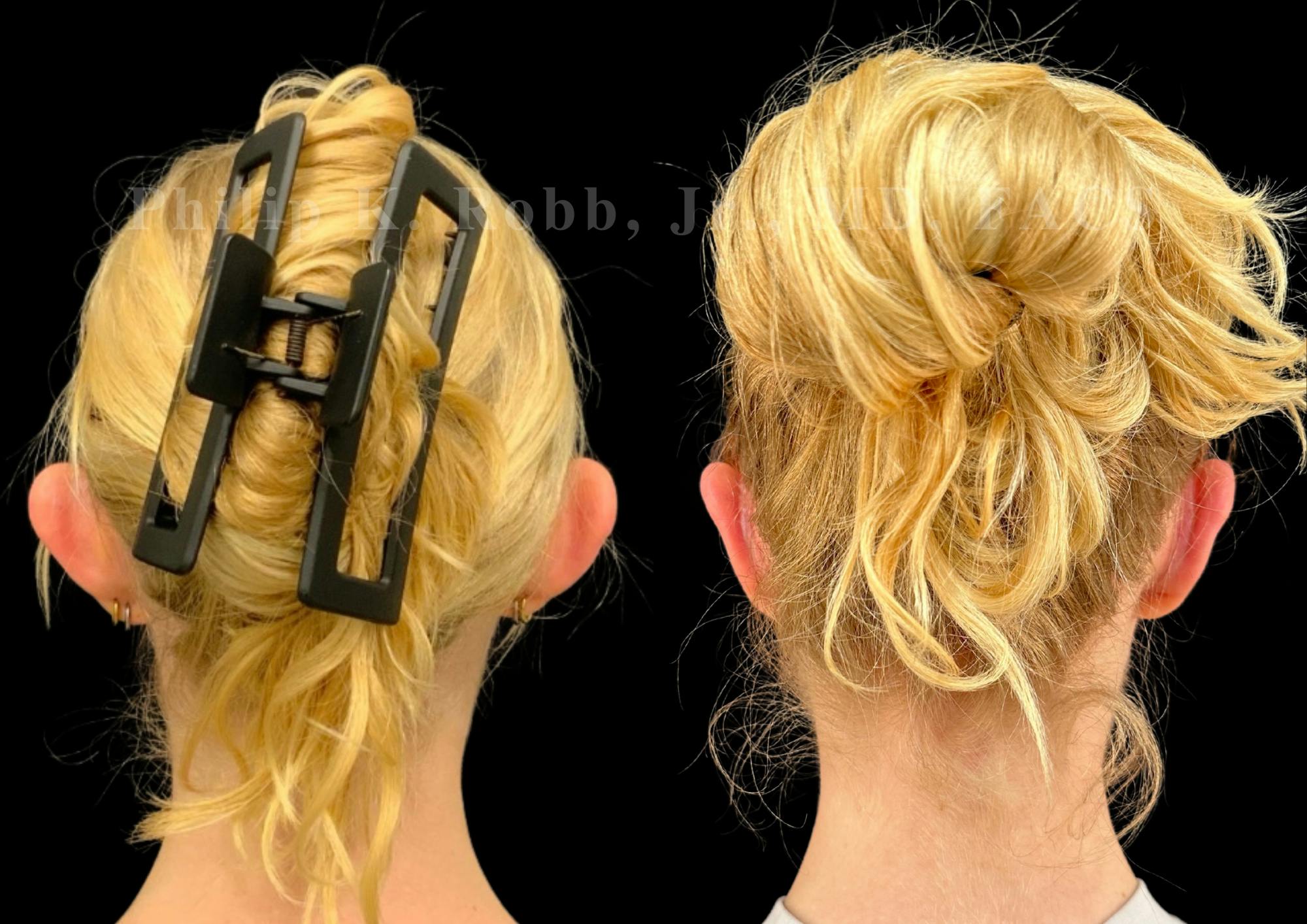 Otoplasty Before & After Gallery - Patient 159810 - Image 2