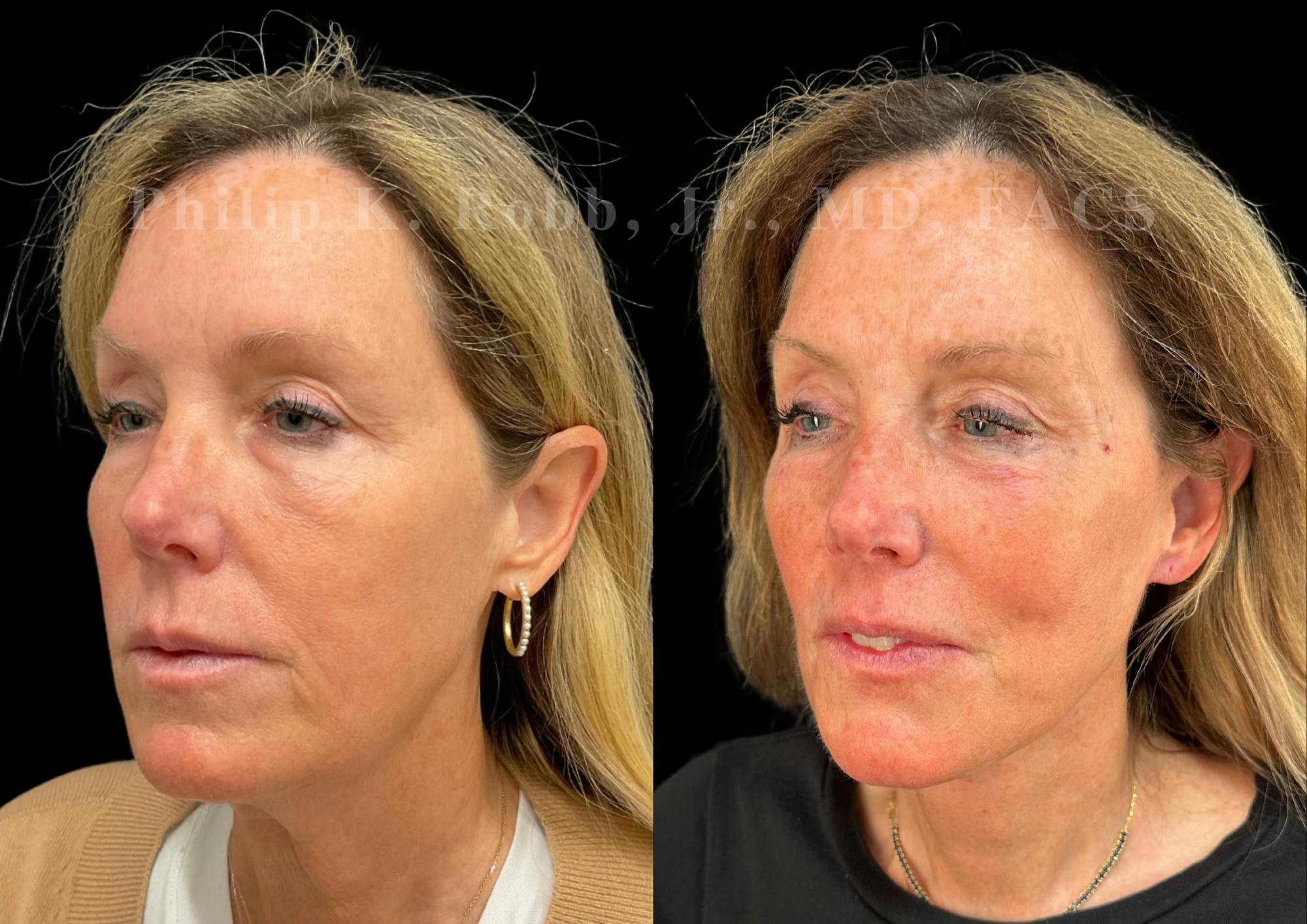 Neck Lift Before & After Gallery - Patient 211728 - Image 2