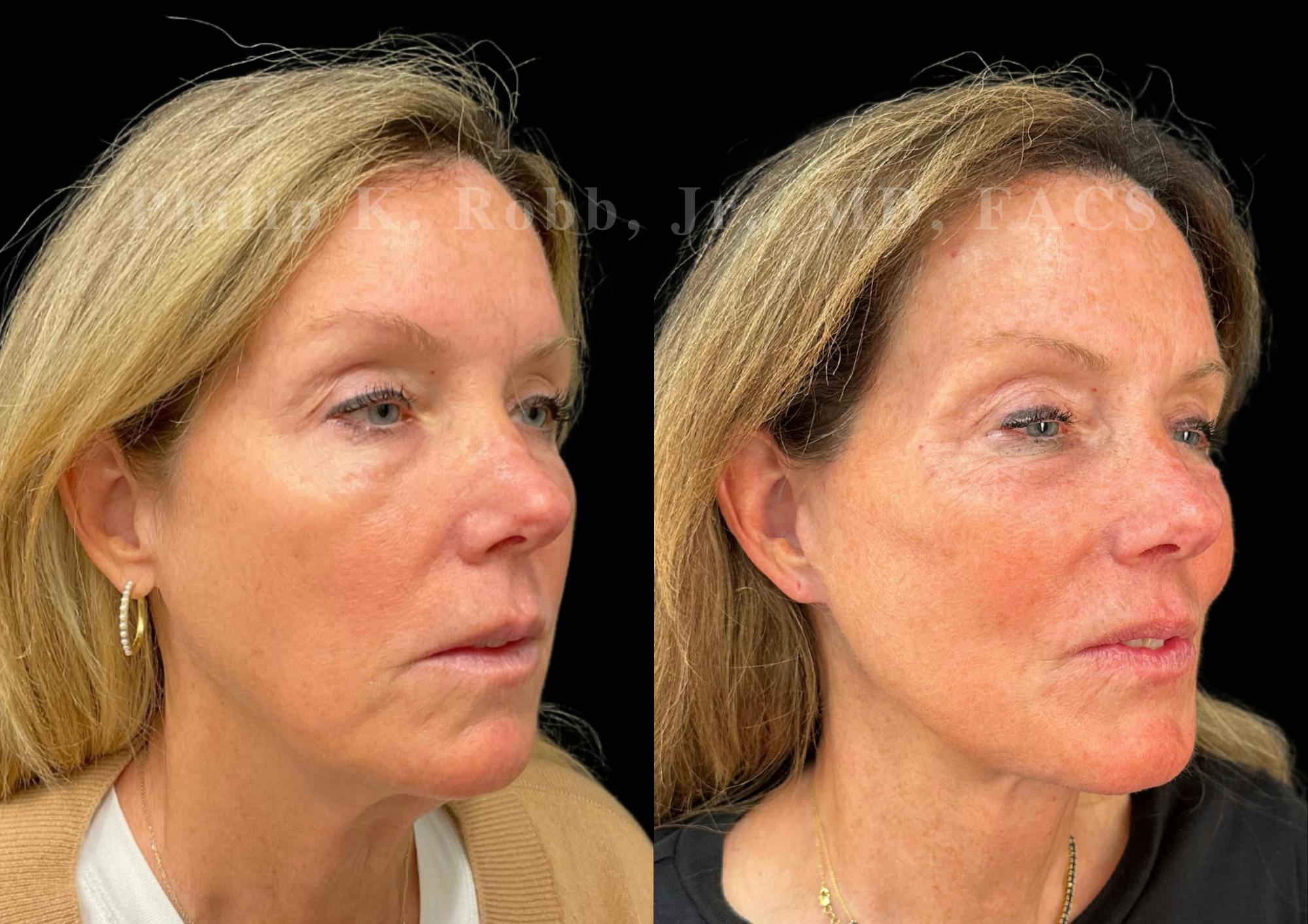 Neck Lift Before & After Gallery - Patient 211728 - Image 4