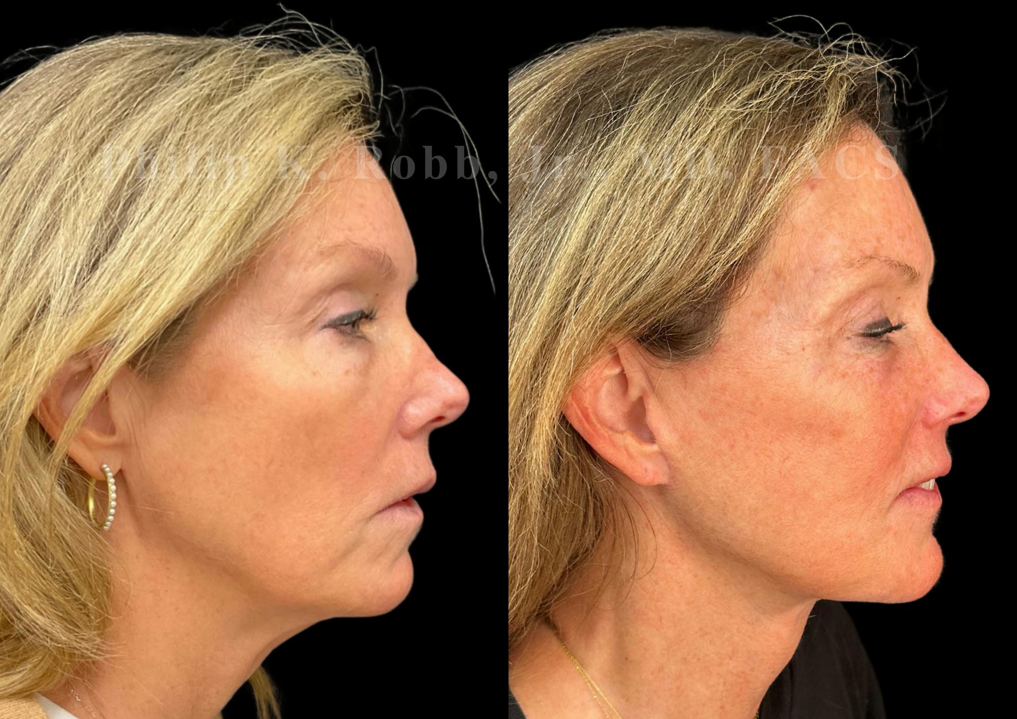 Neck Lift Before & After Gallery - Patient 211728 - Image 5