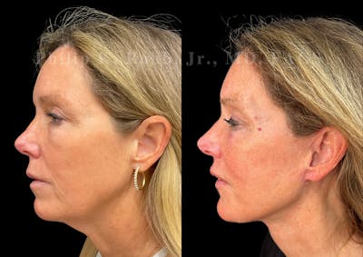 Neck Lift Before & After Gallery - Patient 211728 - Image 1