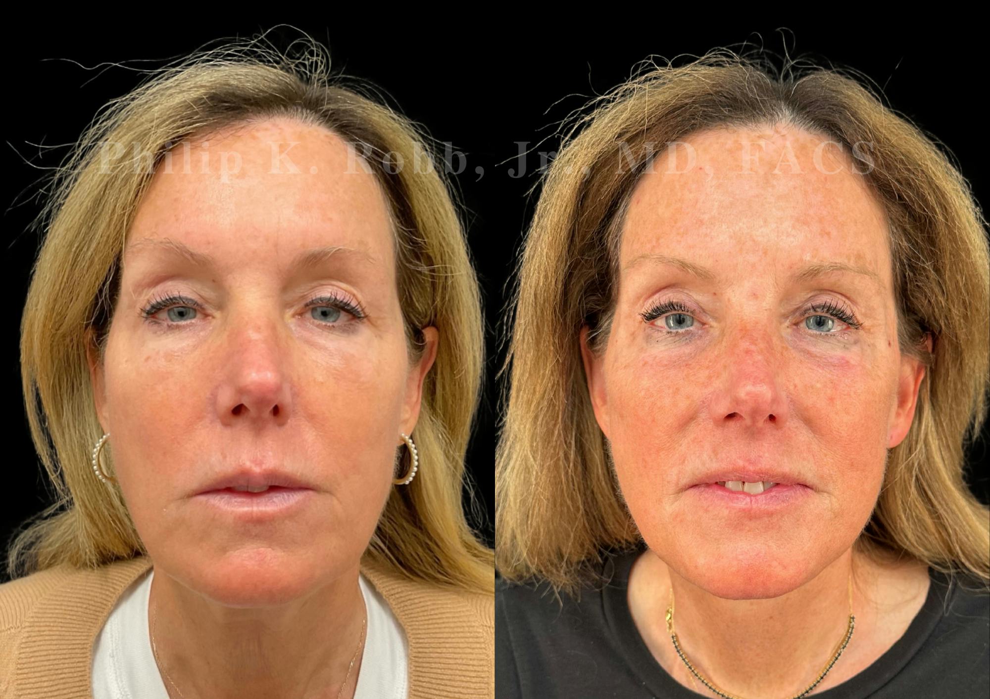 Neck Lift Before & After Gallery - Patient 211728 - Image 3