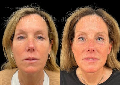 Brow Lift Before & After Gallery - Patient 396769 - Image 1