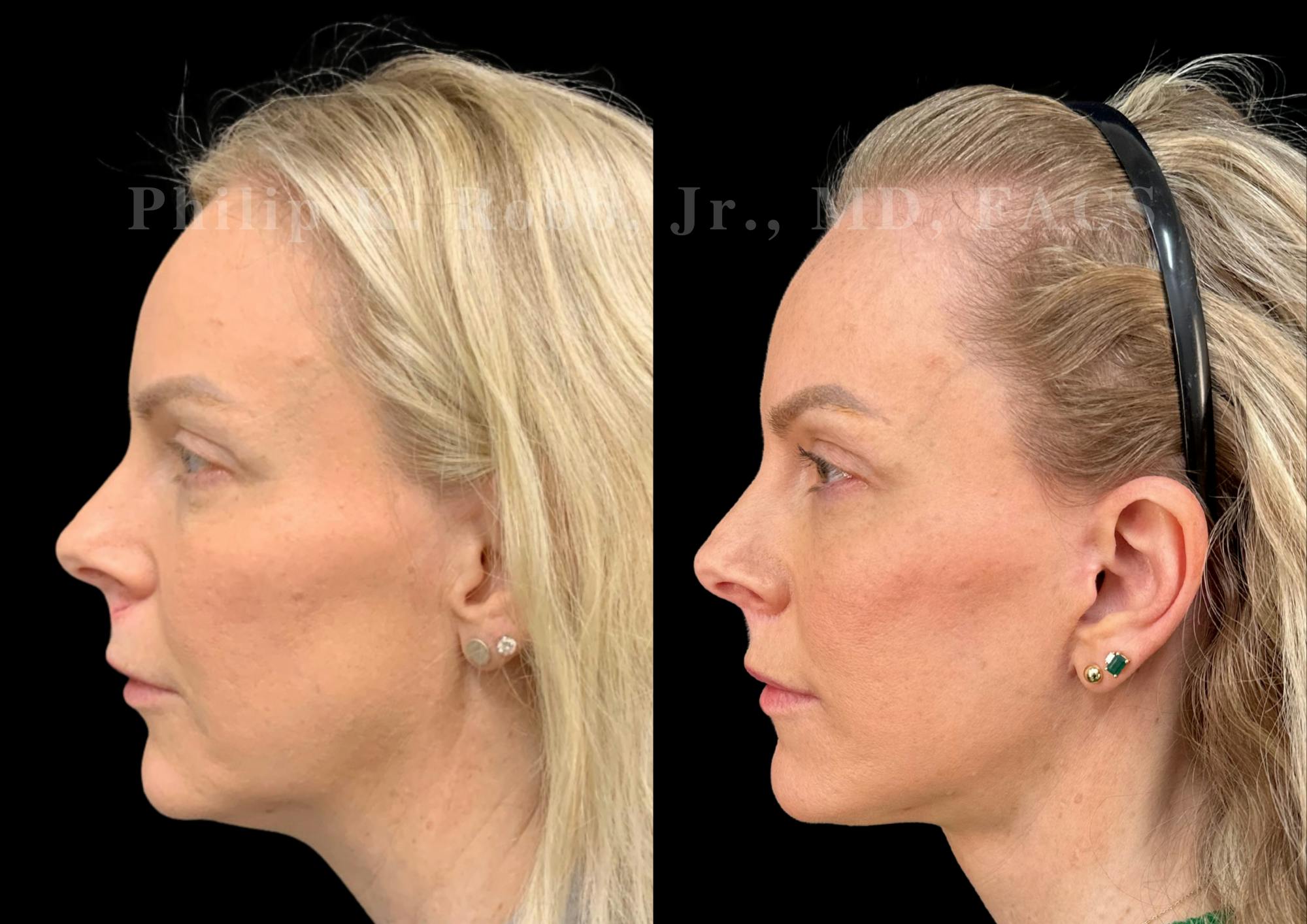 Lip Lift Before & After Gallery - Patient 931110 - Image 3