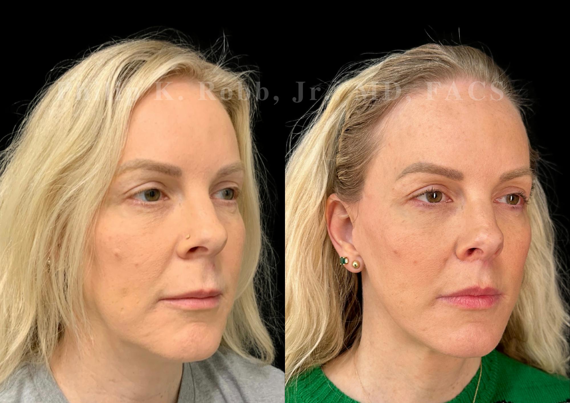 Lip Lift Before & After Gallery - Patient 931110 - Image 5