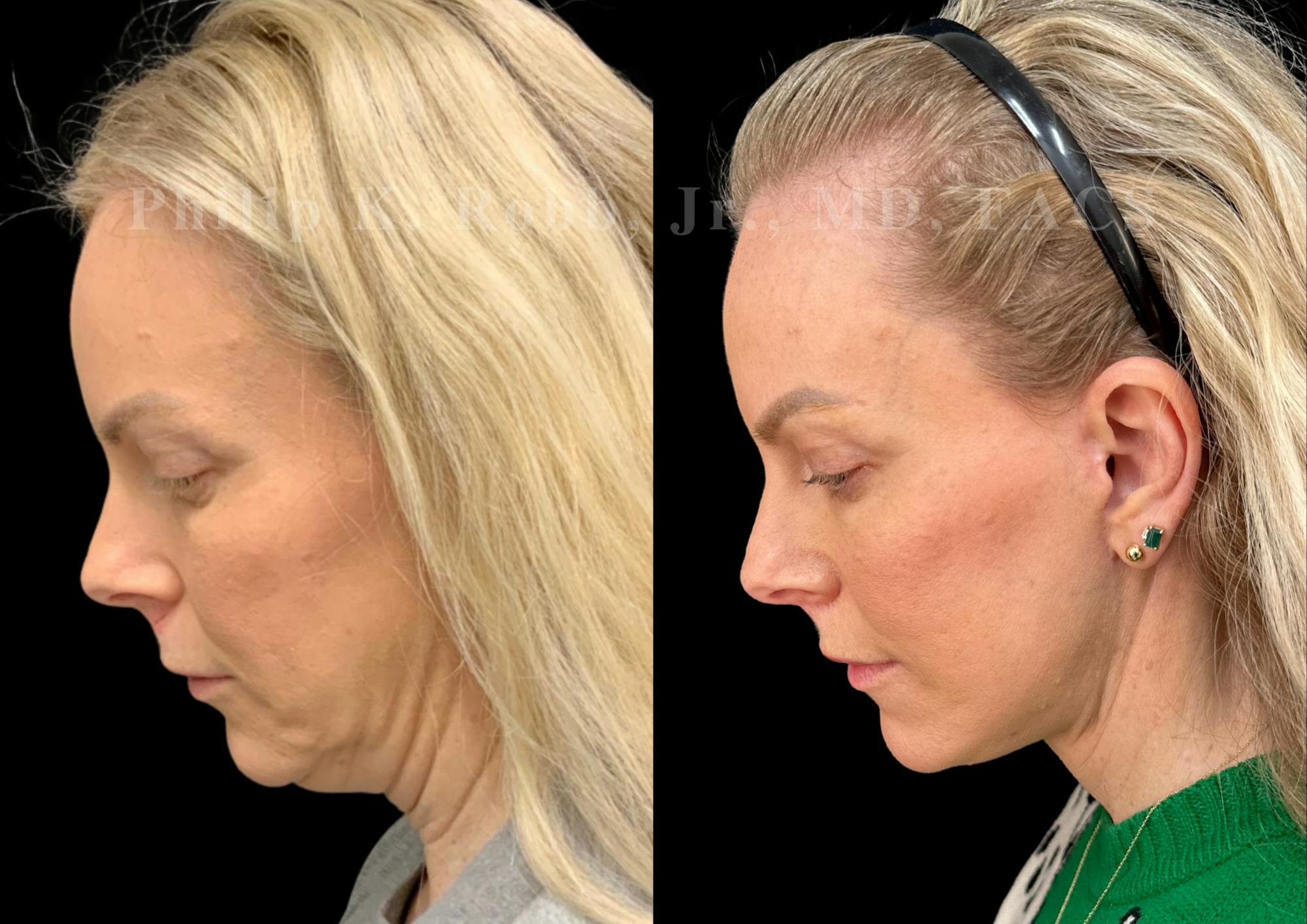 Lip Lift Before & After Gallery - Patient 931110 - Image 2