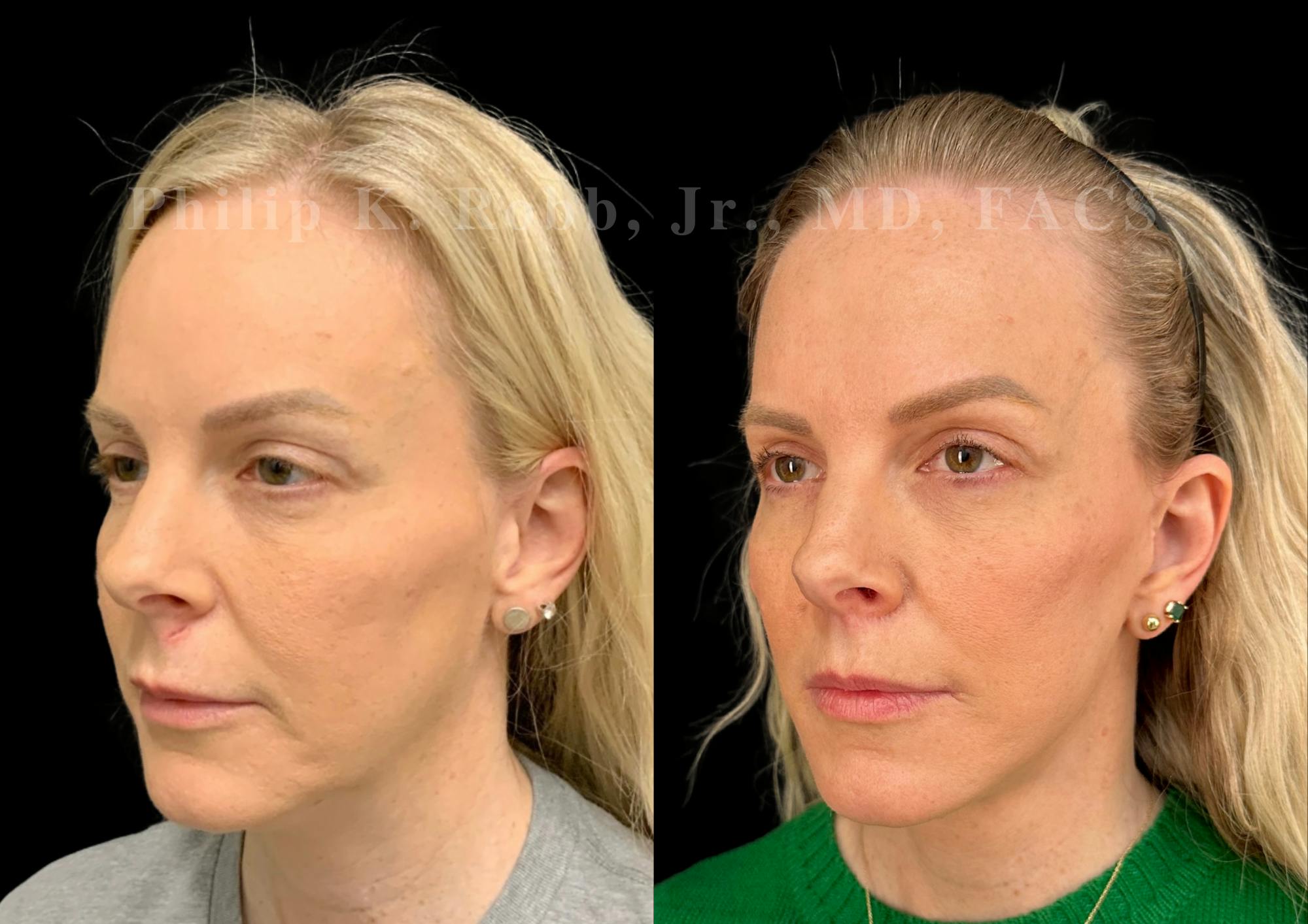 Lip Lift Before & After Gallery - Patient 931110 - Image 4