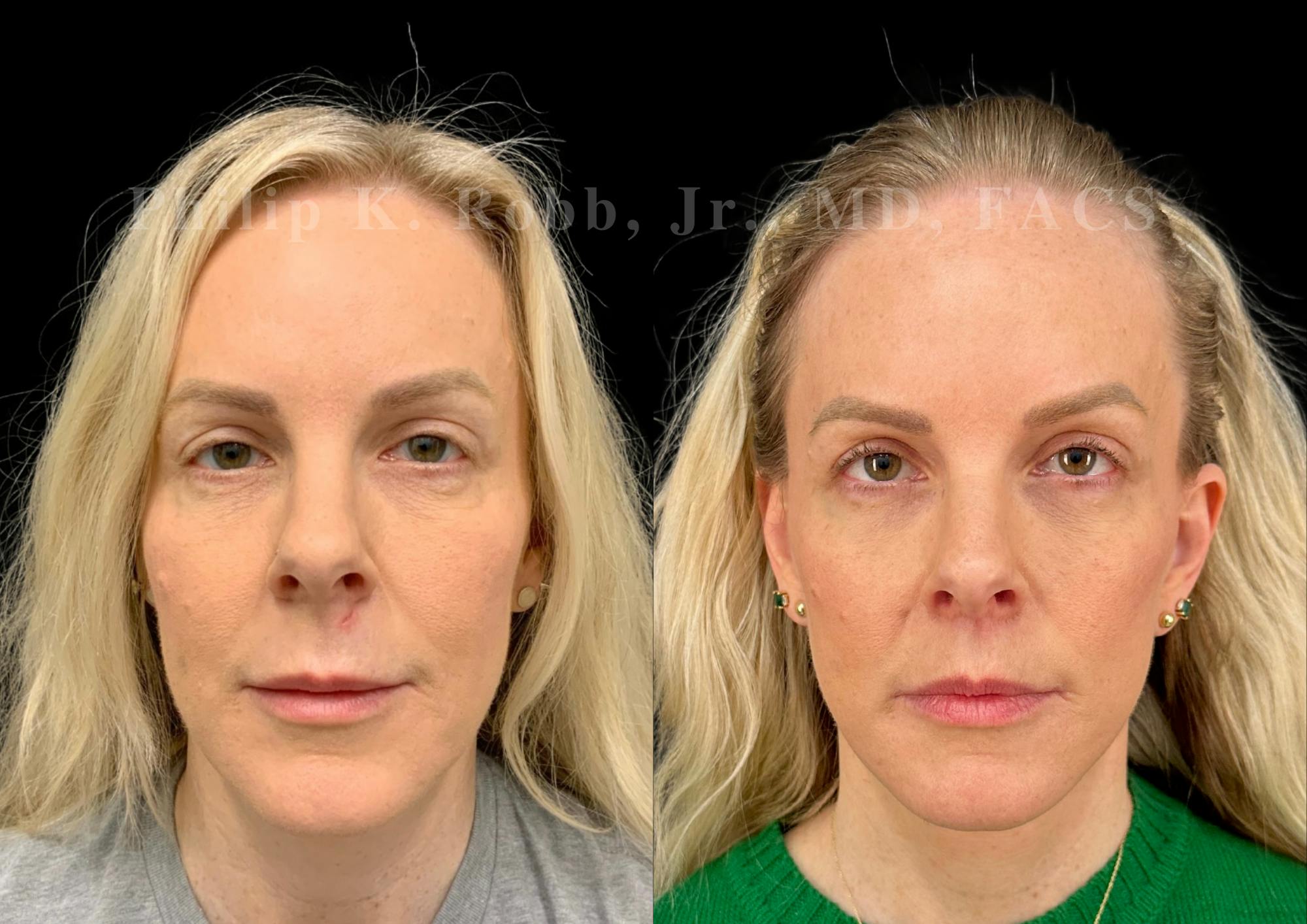 Lip Lift Before & After Gallery - Patient 931110 - Image 1