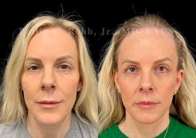 Lip Lift Before & After Gallery - Patient 931110 - Image 1