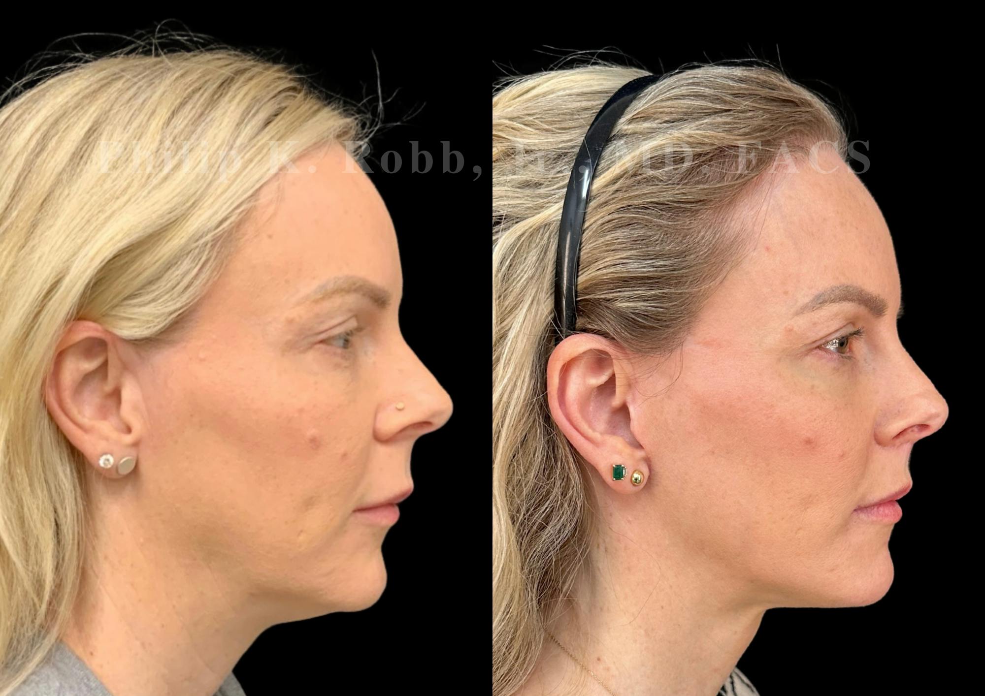 Lip Lift Before & After Gallery - Patient 931110 - Image 6