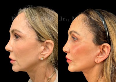 Neck Lift Before & After Gallery - Patient 156487 - Image 1