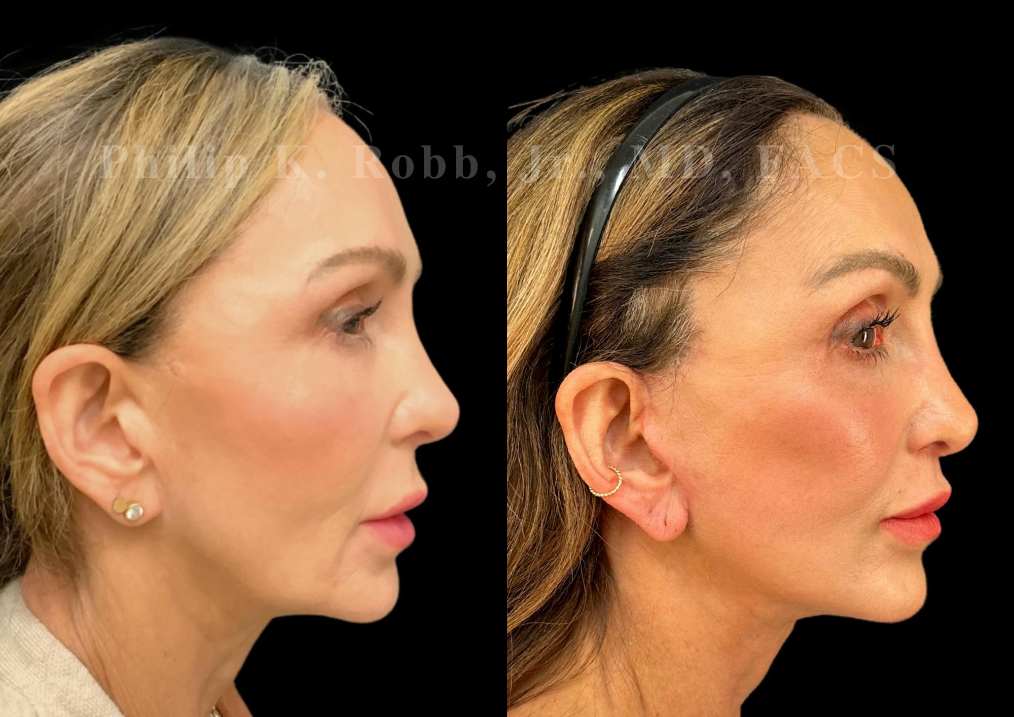 Neck Lift Before & After Gallery - Patient 156487 - Image 6