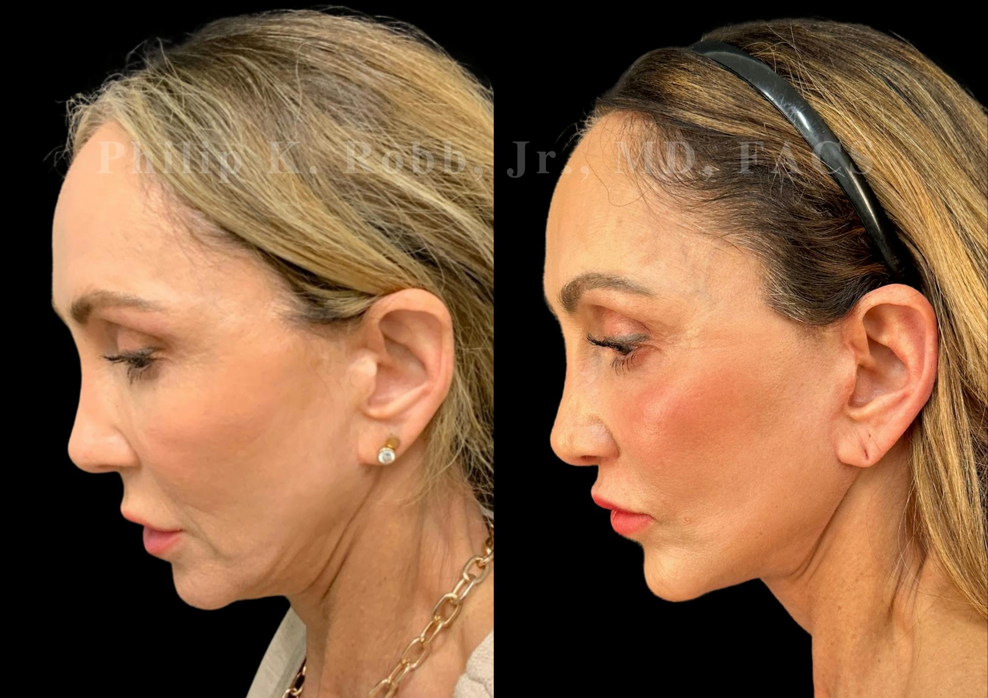 Neck Lift Before & After Gallery - Patient 156487 - Image 2