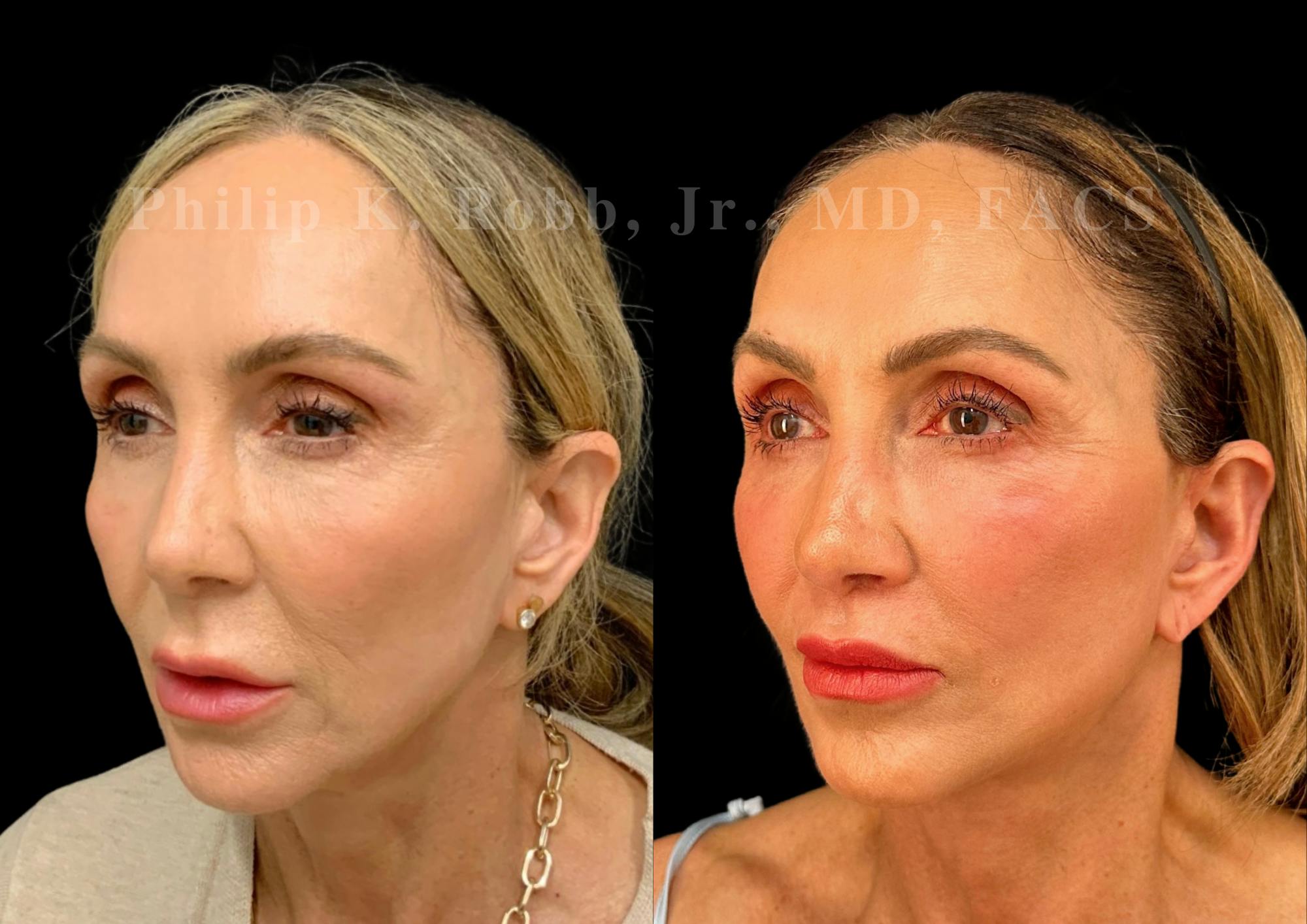 Neck Lift Before & After Gallery - Patient 156487 - Image 3