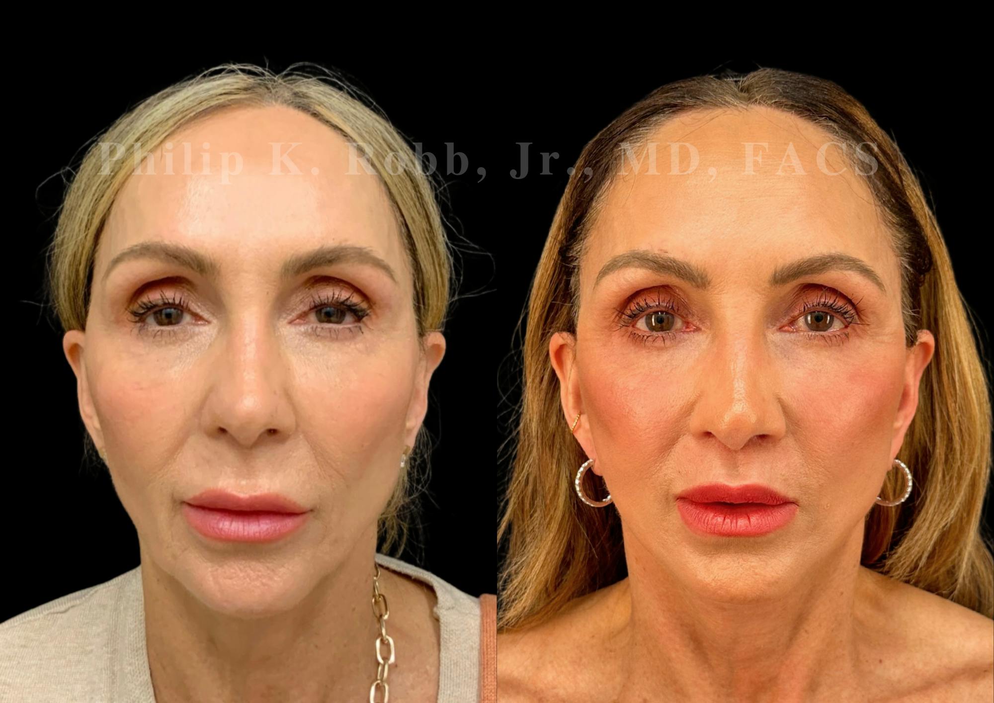 Neck Lift Before & After Gallery - Patient 156487 - Image 4