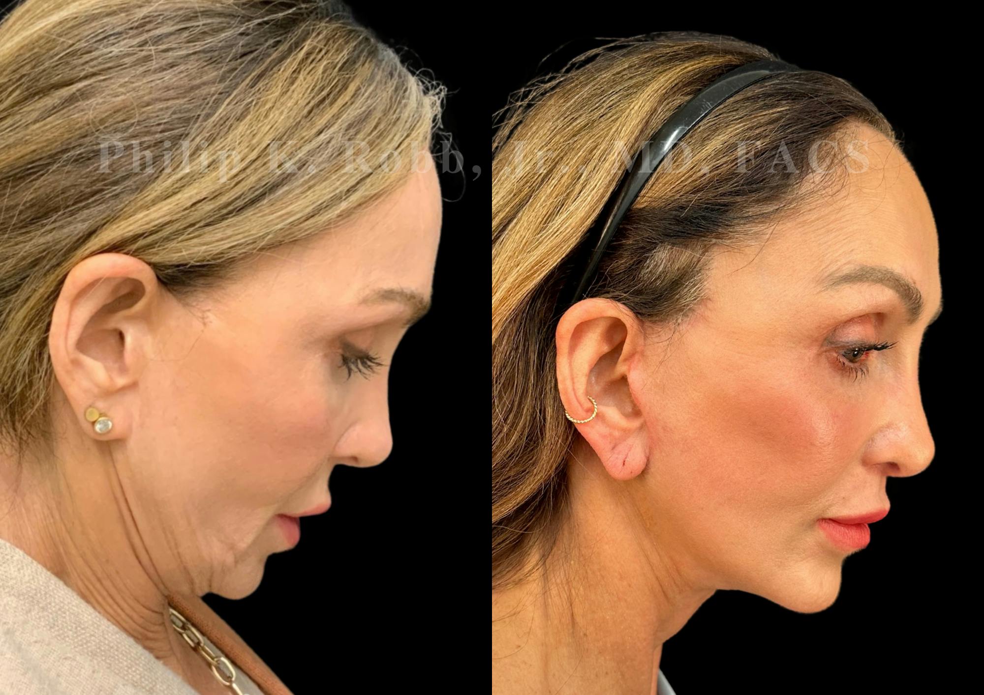 Neck Lift Before & After Gallery - Patient 156487 - Image 7