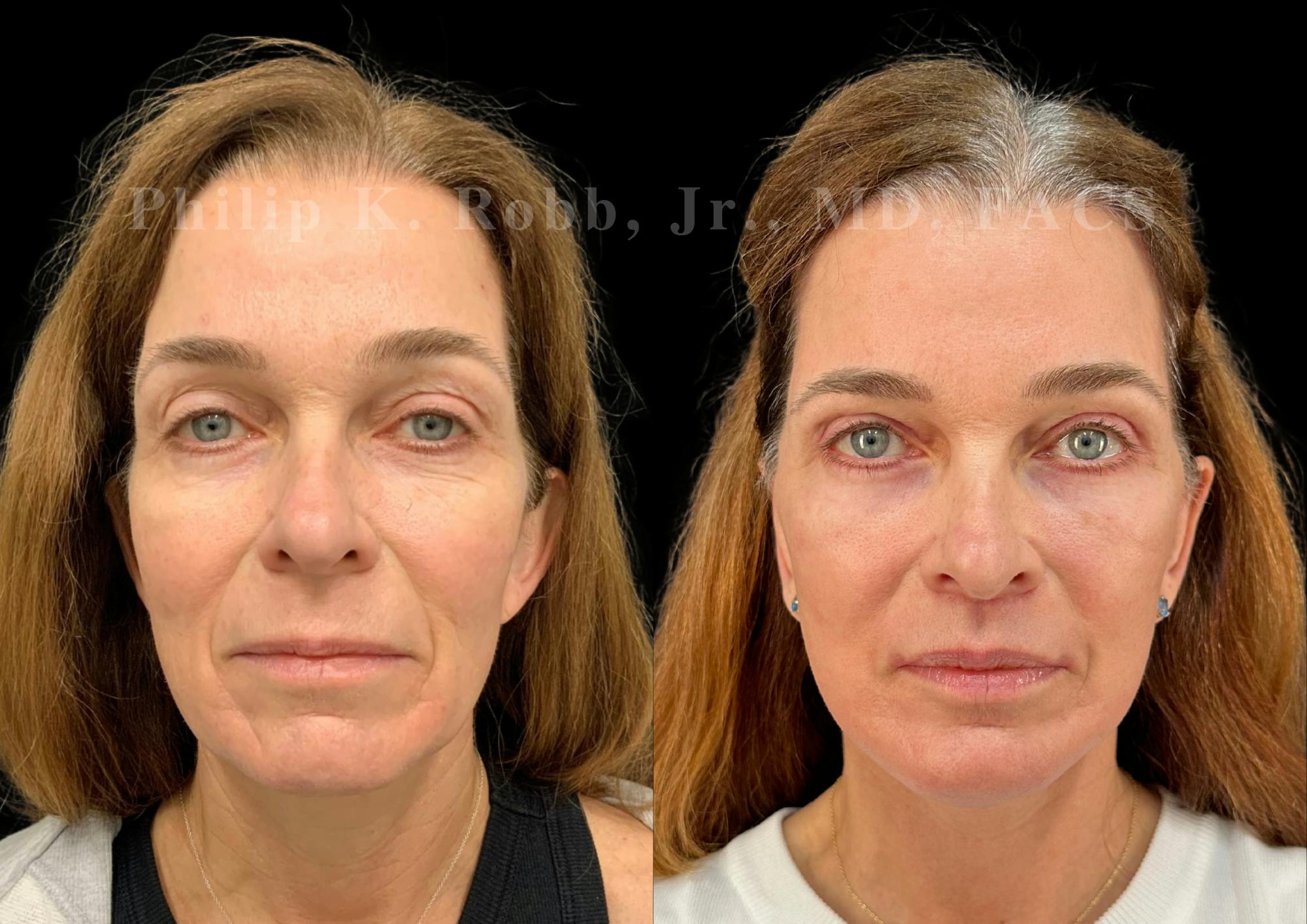 Upper Blepharoplasty Before & After Gallery - Patient 897303 - Image 1