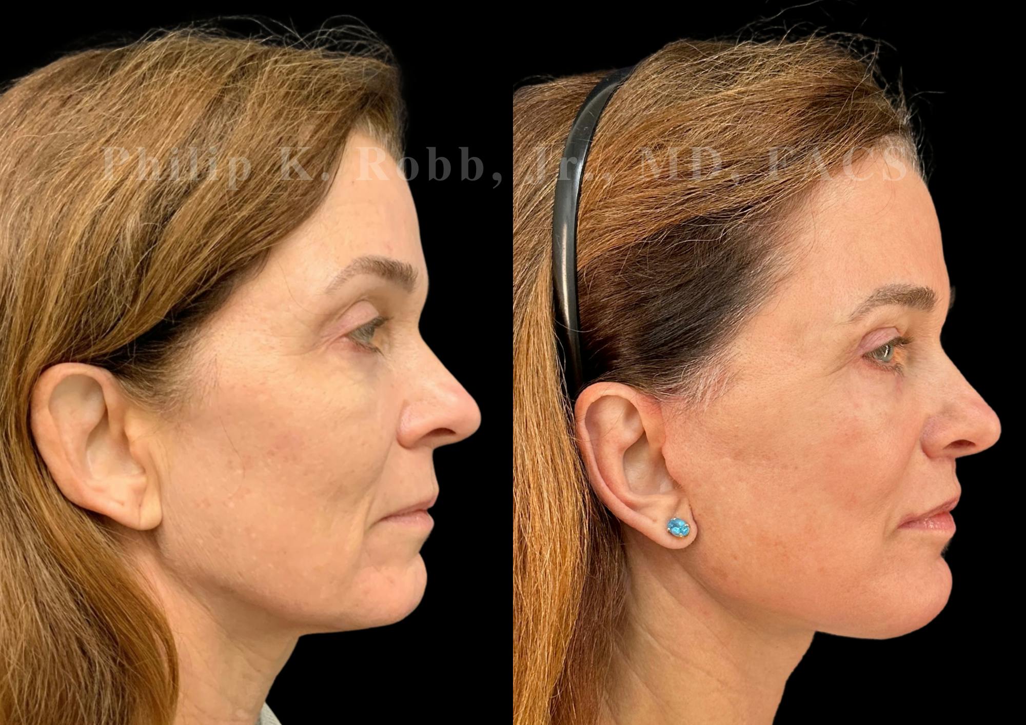 Upper Blepharoplasty Before & After Gallery - Patient 897303 - Image 6