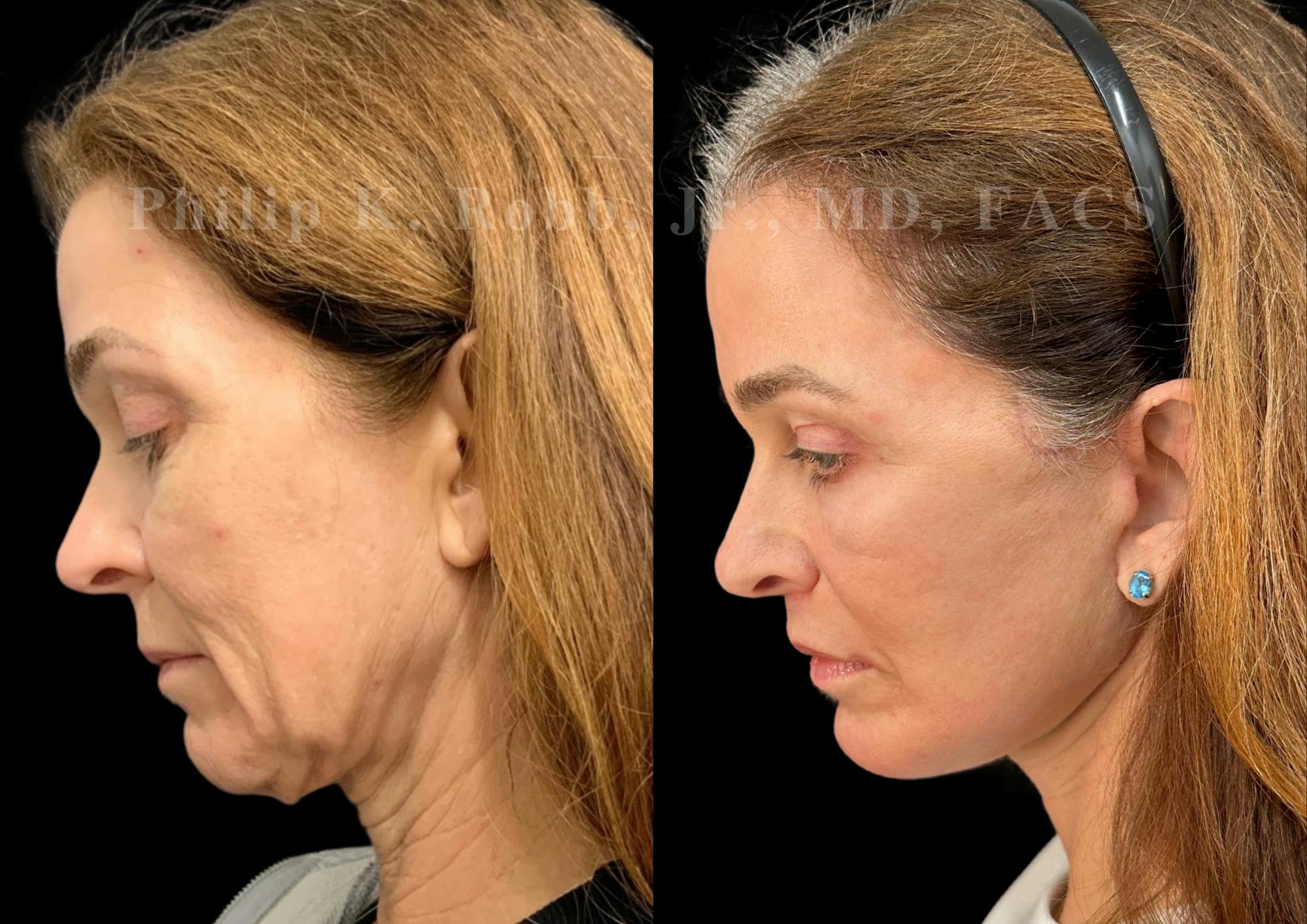 Upper Blepharoplasty Before & After Gallery - Patient 897303 - Image 2