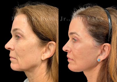 Neck Lift Before & After Gallery - Patient 360405 - Image 1
