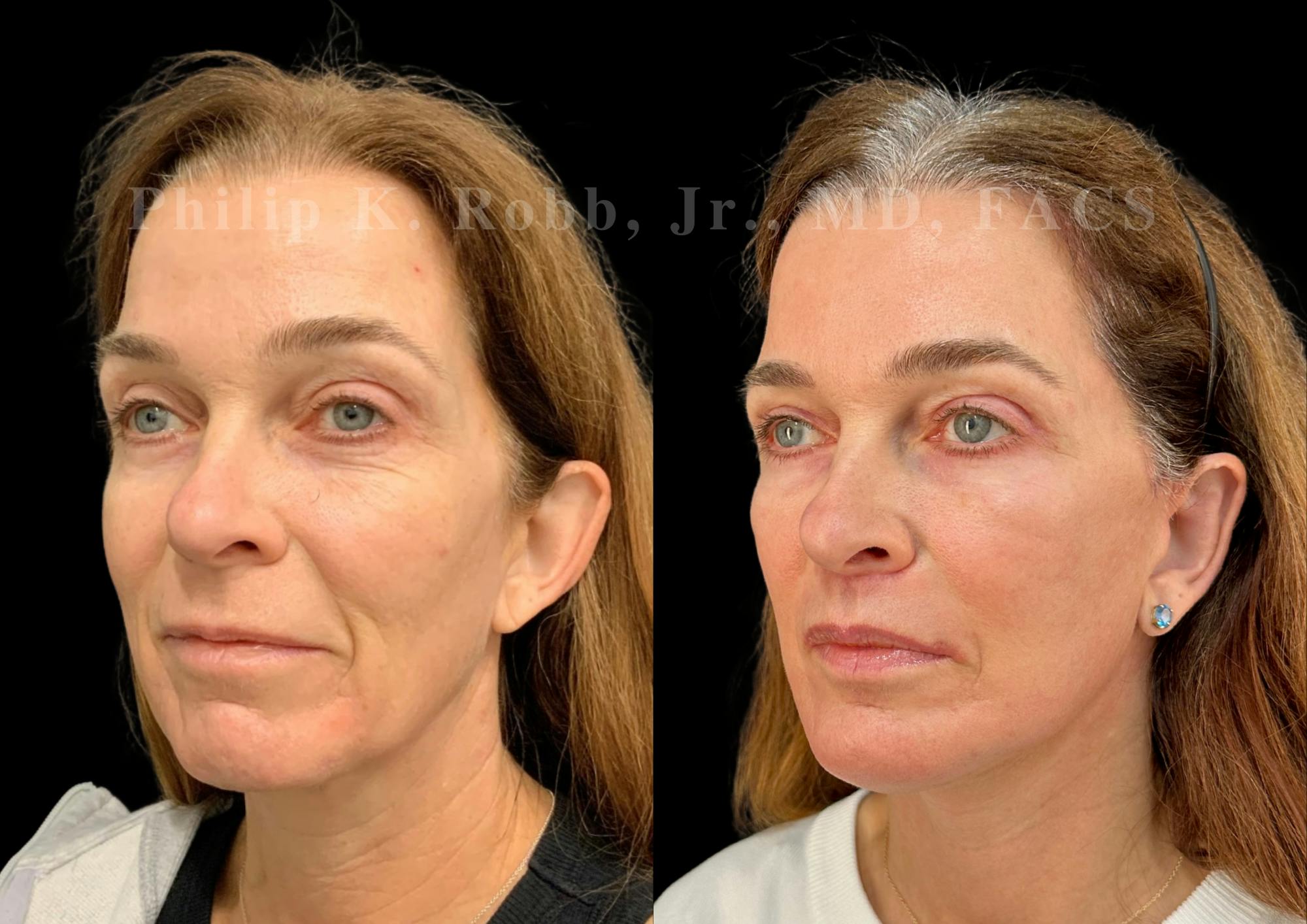 Upper Blepharoplasty Before & After Gallery - Patient 897303 - Image 4