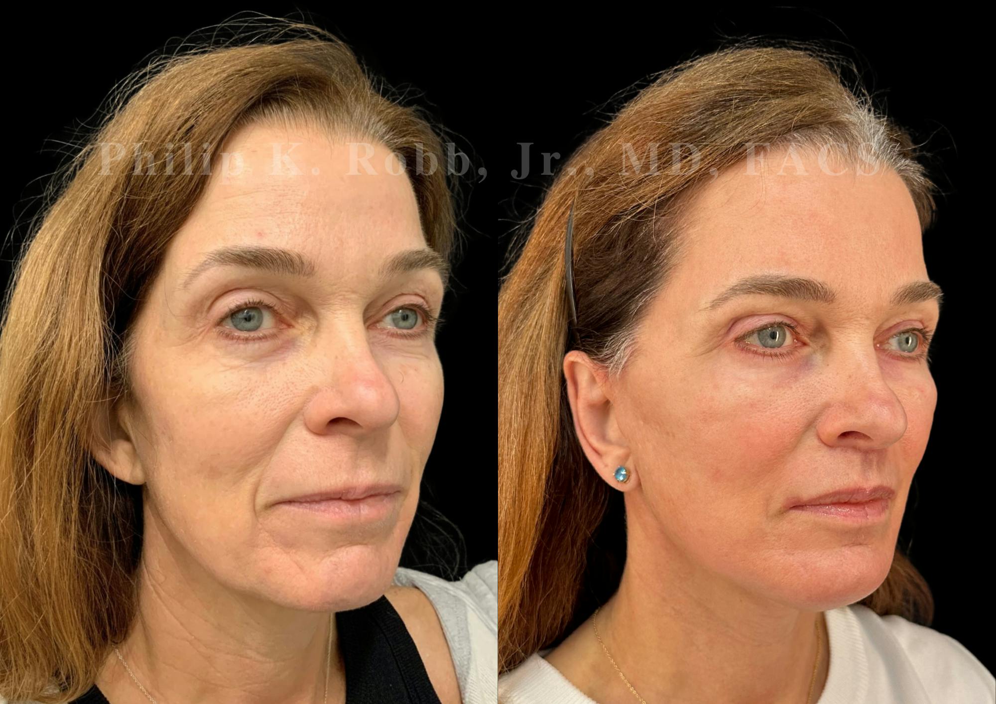 Upper Blepharoplasty Before & After Gallery - Patient 897303 - Image 5