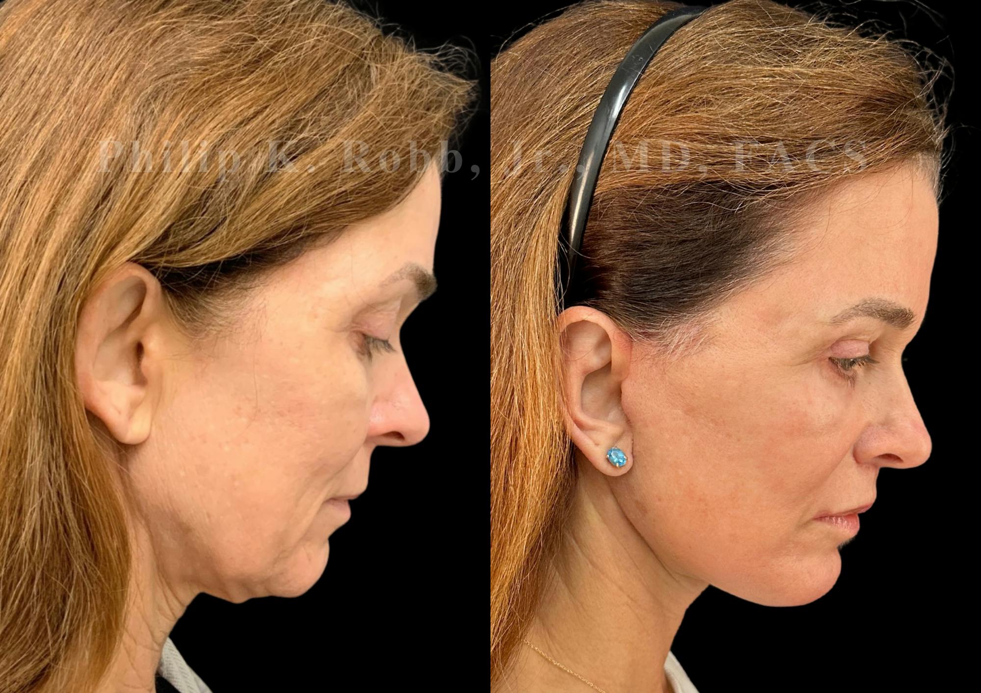 Upper Blepharoplasty Before & After Gallery - Patient 897303 - Image 7