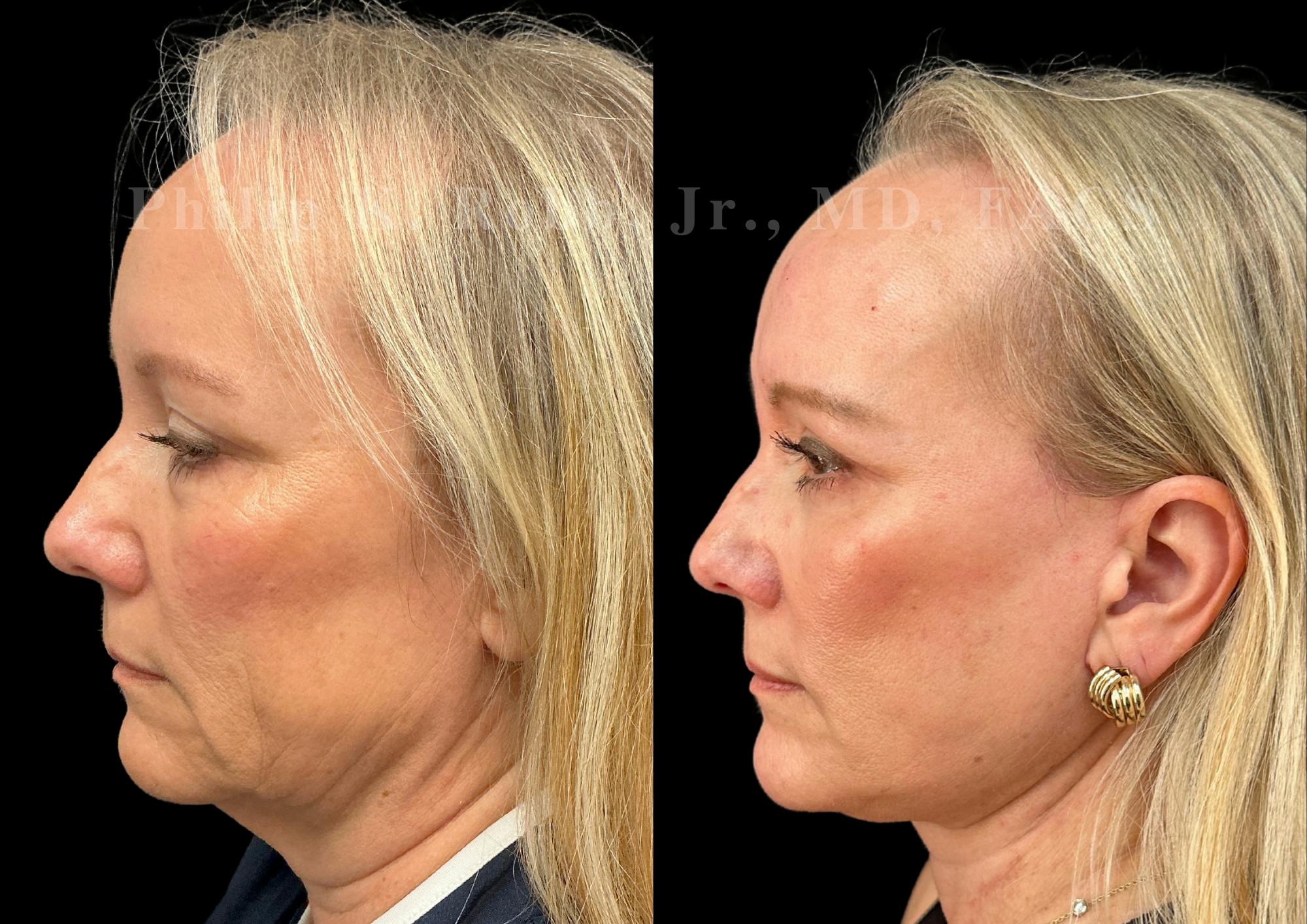 Neck Lift Before & After Gallery - Patient 707661 - Image 1
